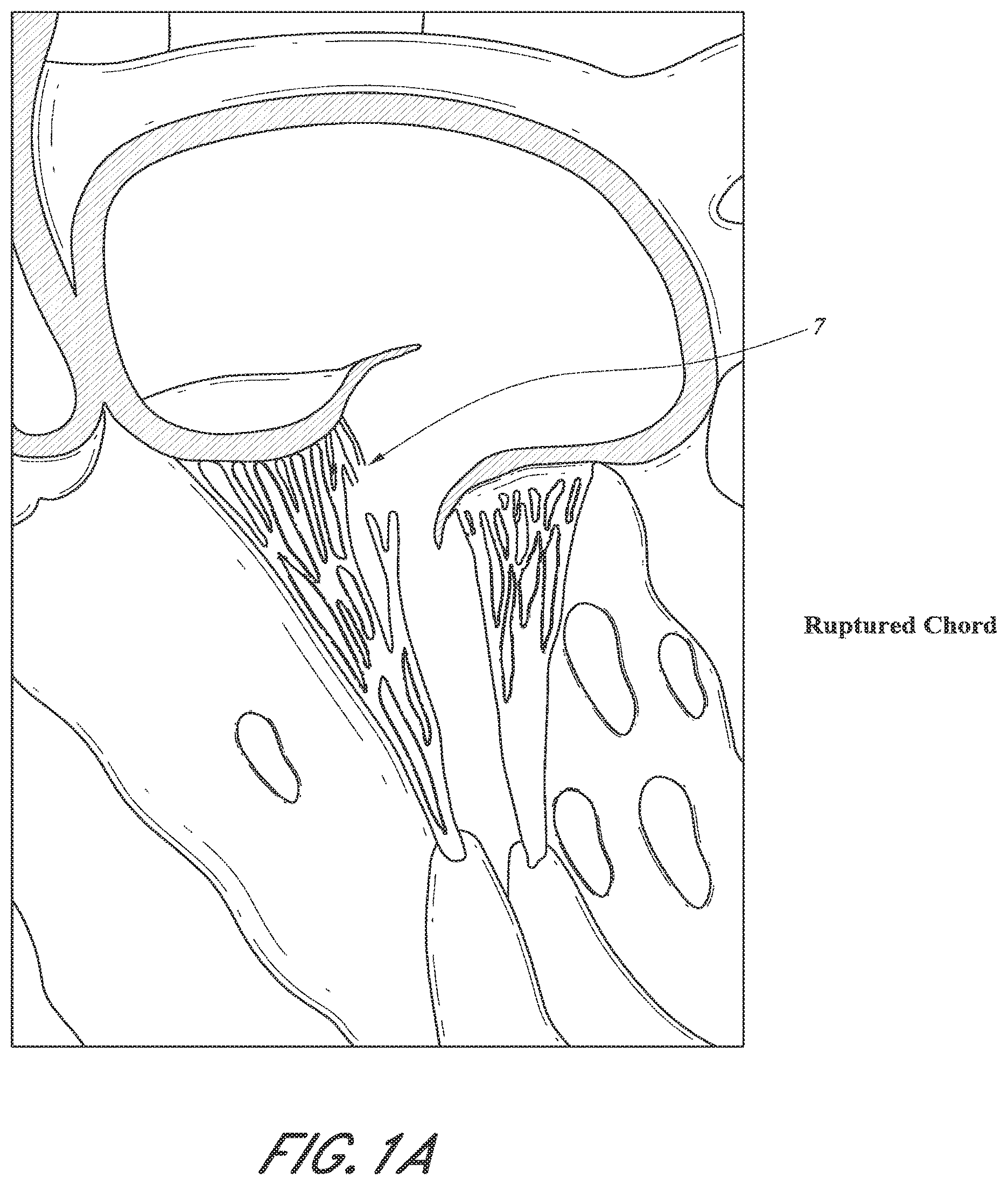 Patent US12318296 Figure 2 – Mitral leaflet tethering