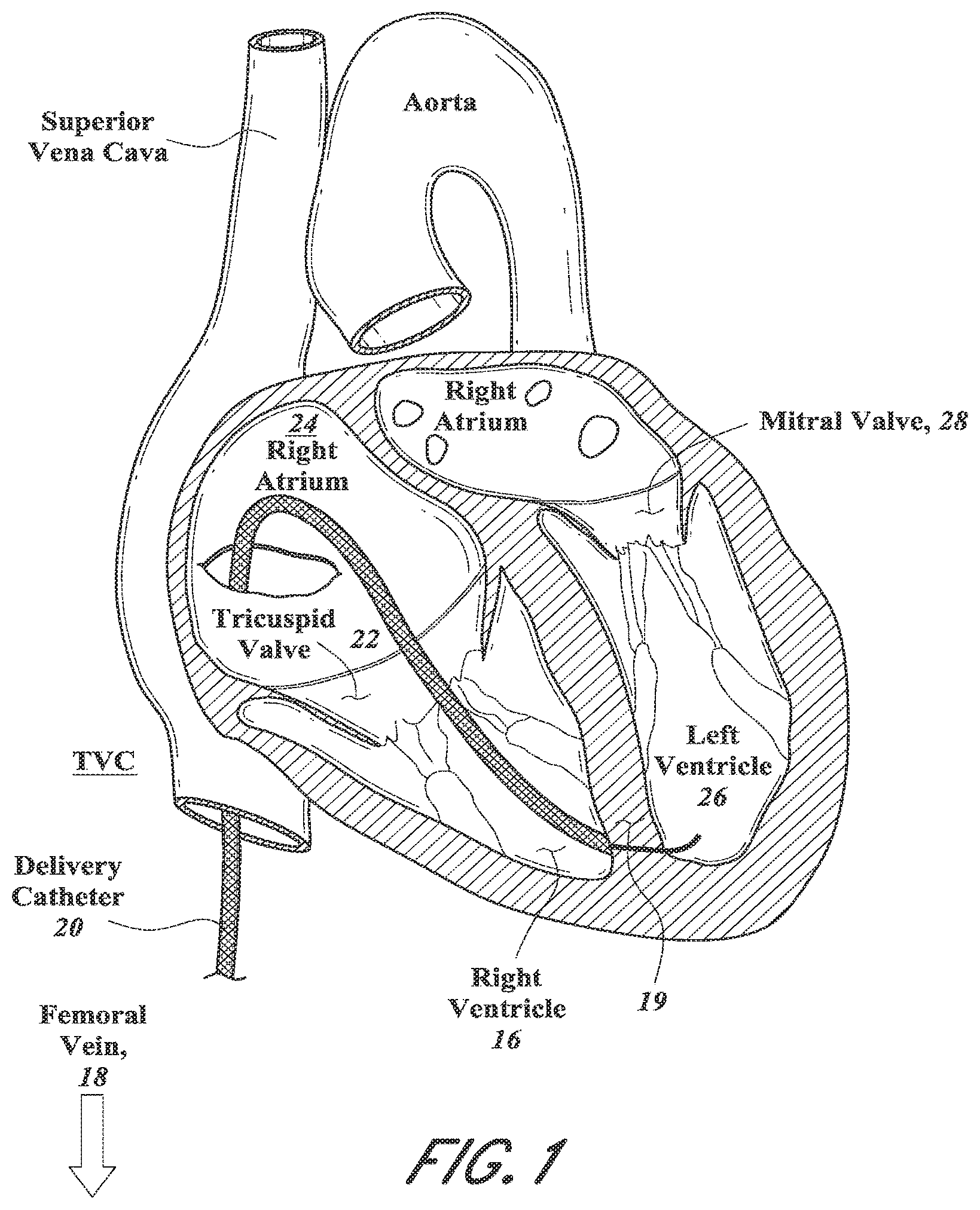 Patent US12318296 Figure 3 – Mitral leaflet tethering