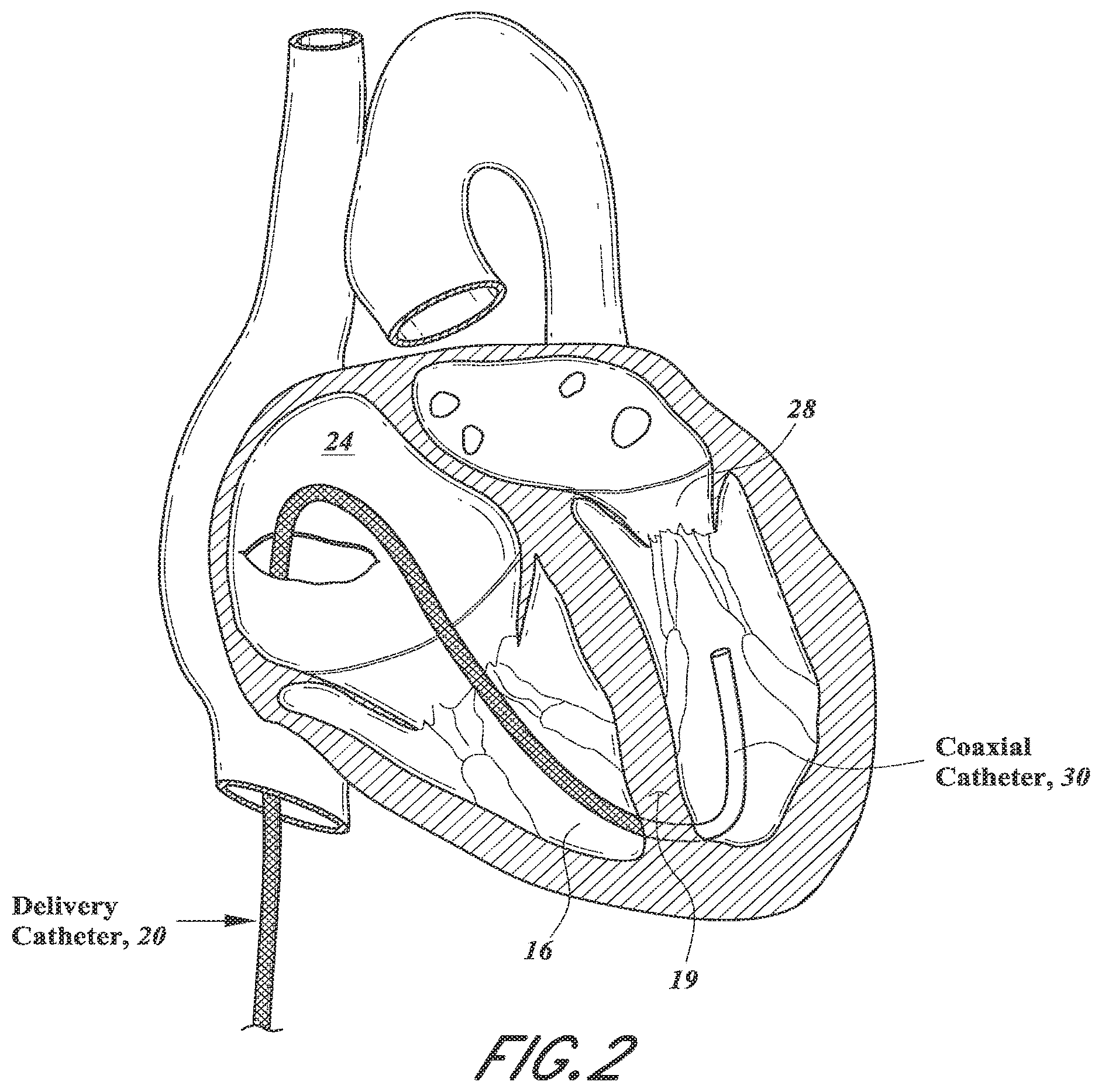 Patent US12318296 Figure 4 – Mitral leaflet tethering