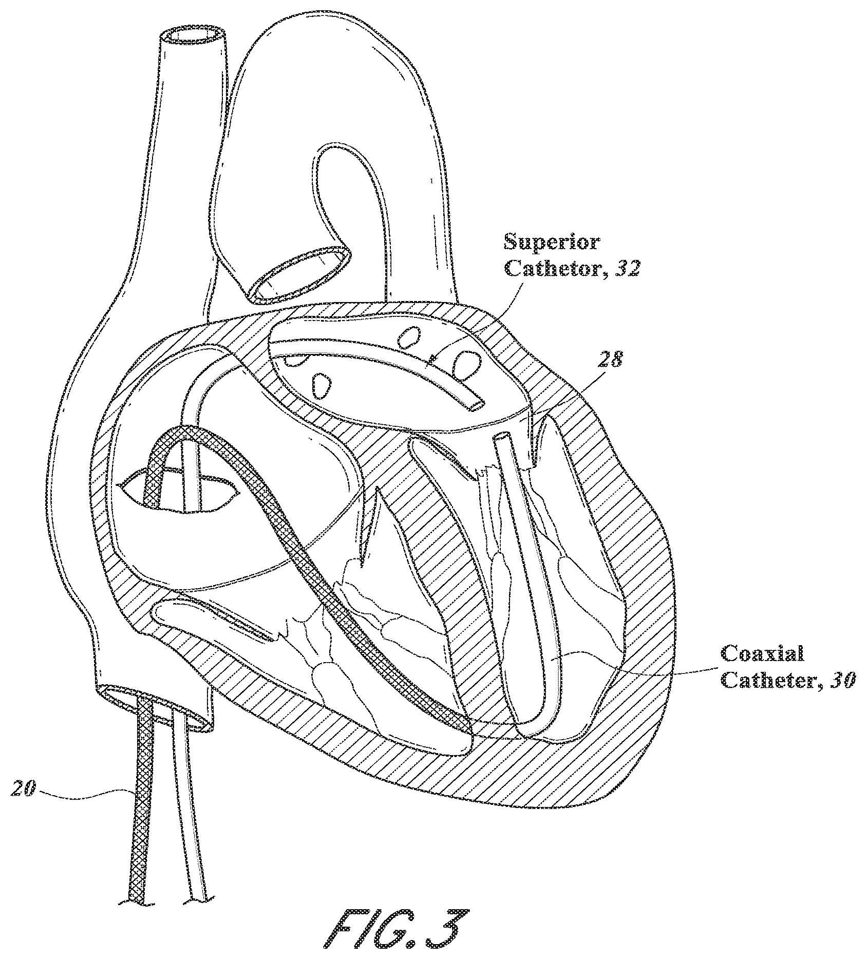 Patent US12318296 Figure 5 – Mitral leaflet tethering