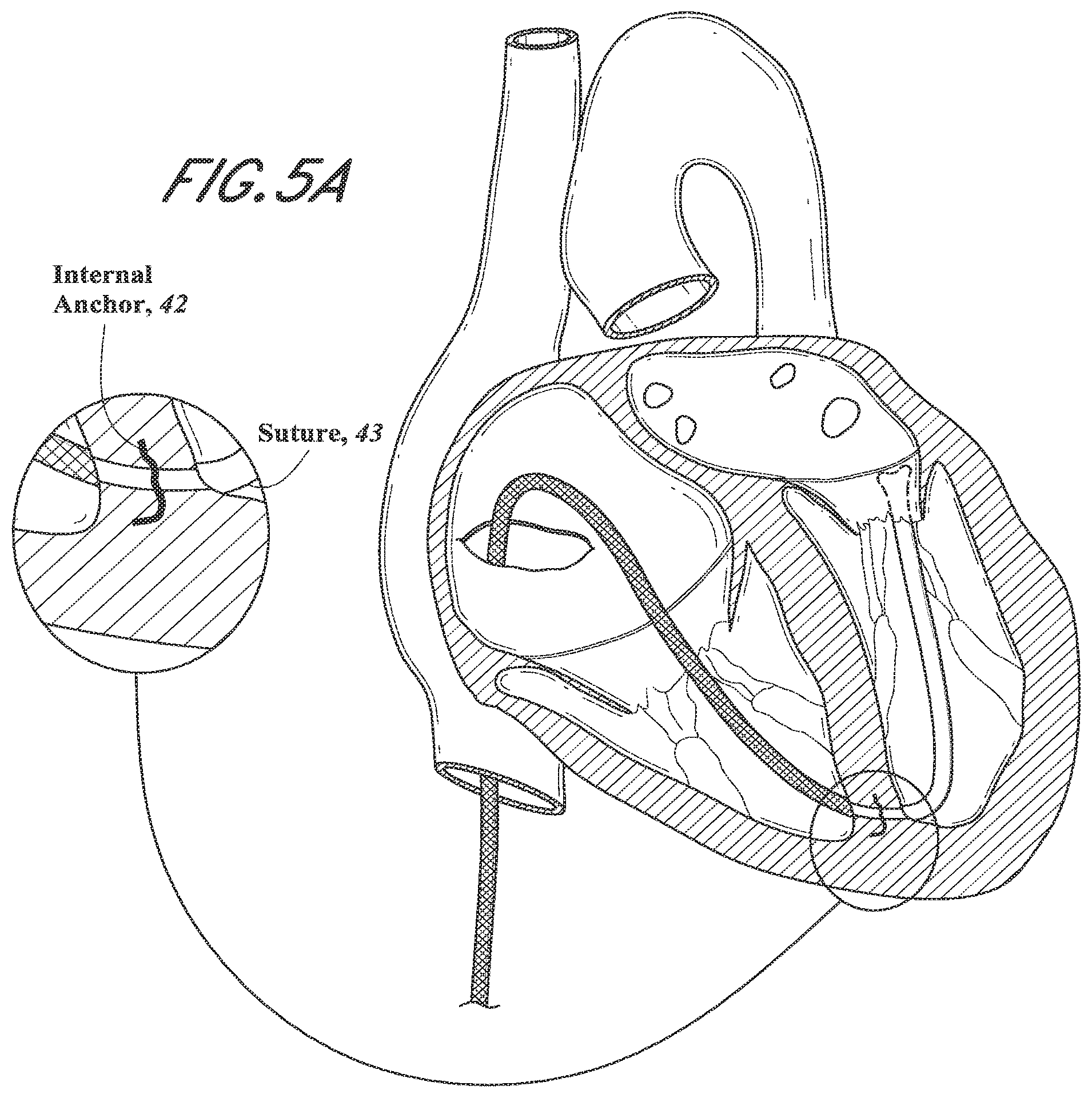Patent US12318296 Figure 9 – Mitral leaflet tethering