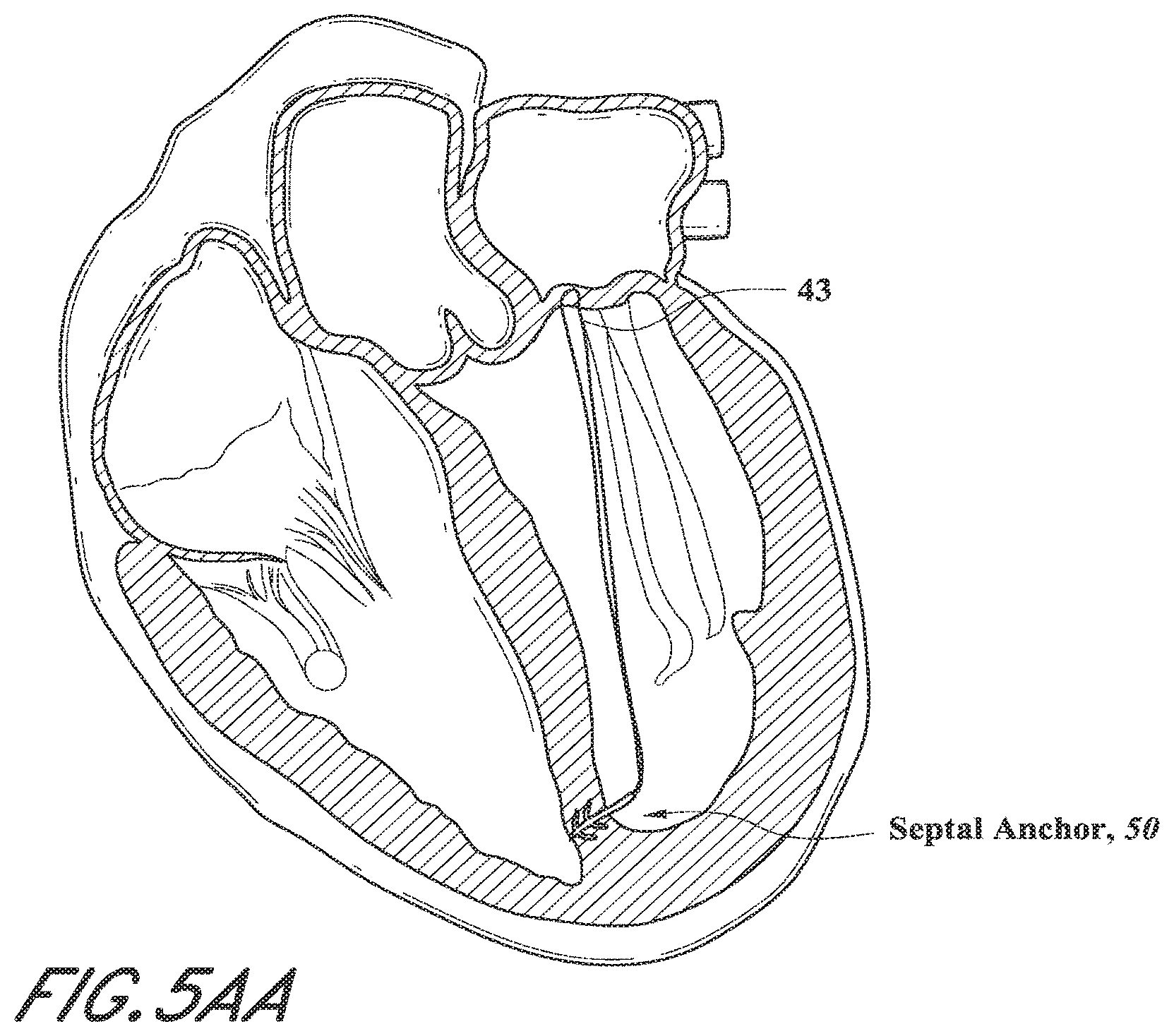 Patent US12318296 Figure 10 – Mitral leaflet tethering