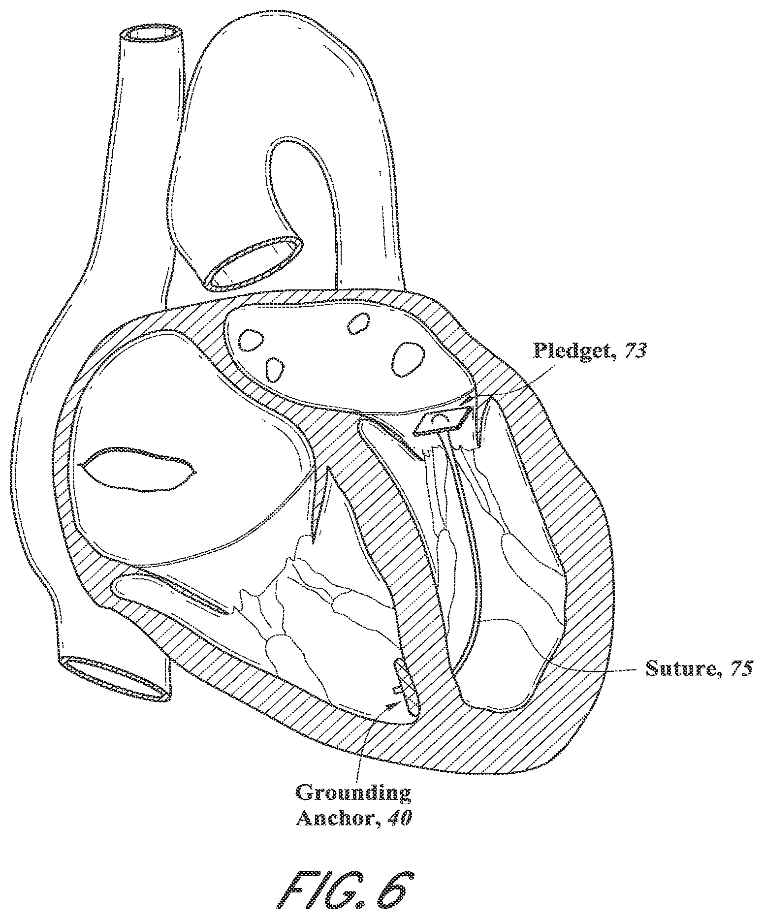 Patent US12318296 Figure 12 – Mitral leaflet tethering
