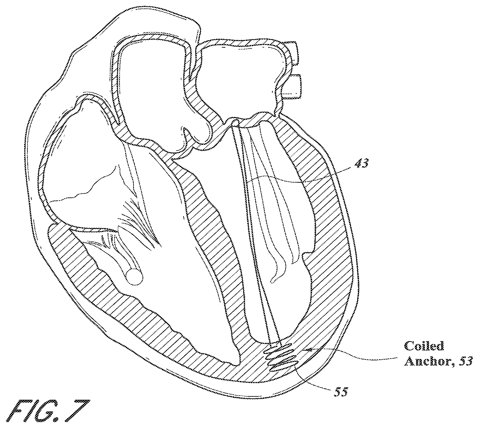Patent US12318296 Figure 13 – Mitral leaflet tethering