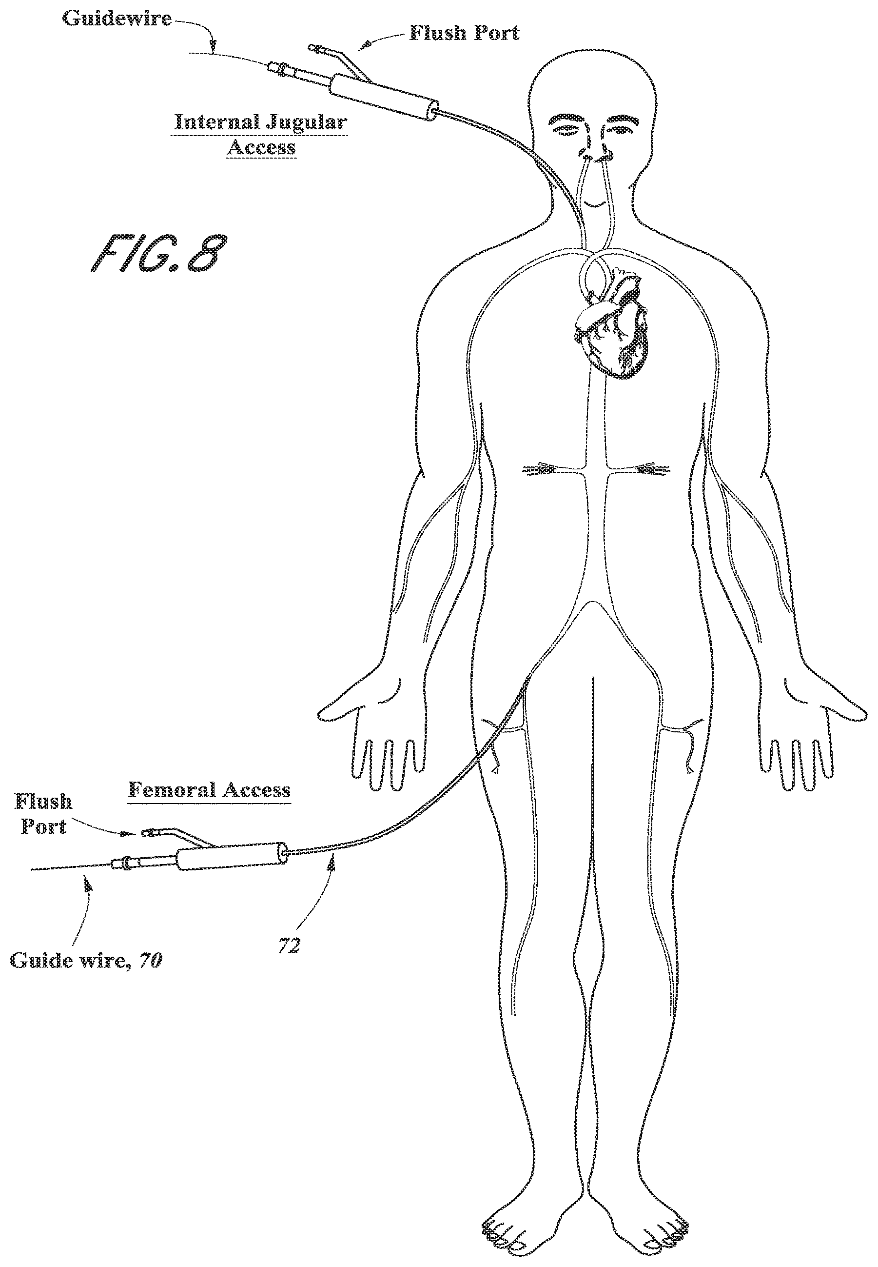 Patent US12318296 Figure 14 – Mitral leaflet tethering