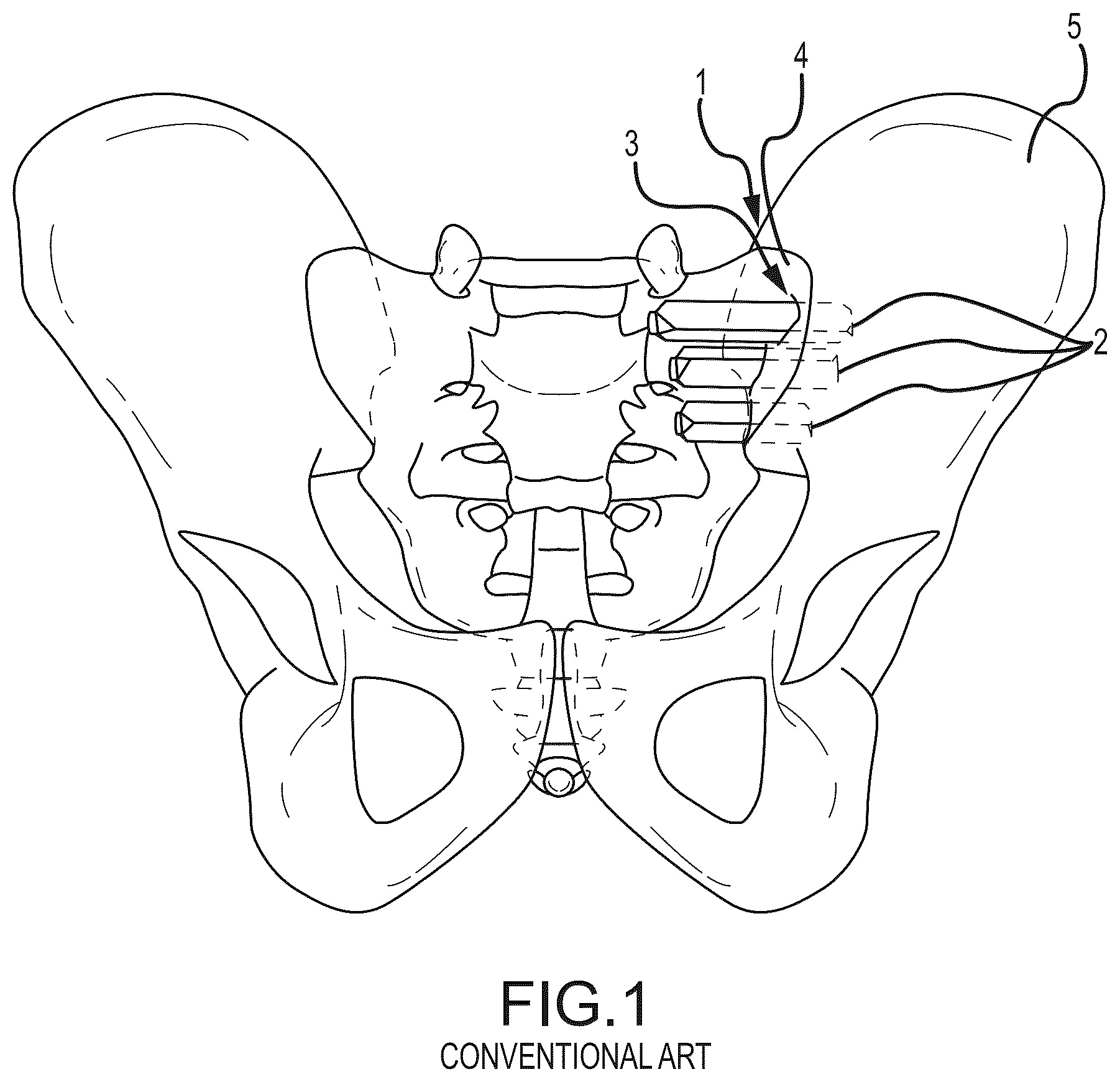 Patent US12318298 Figure 1 – Sacropelvic fusion implant system for providing a foundation for spinopelvic fixation constructs in adult spinal deformity surgery