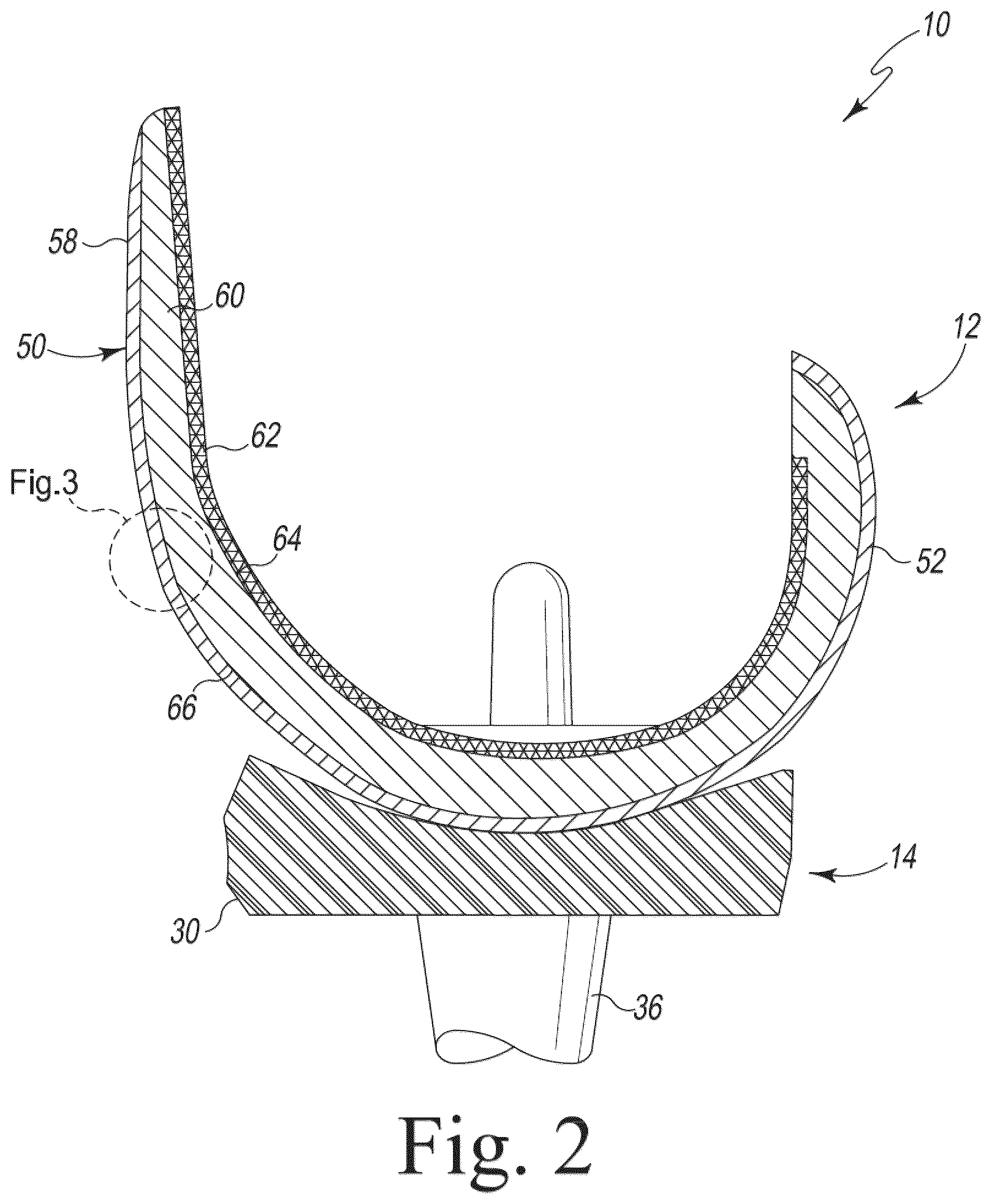 Patent US12318299 Figure 2 – Coated implant and method of making the same