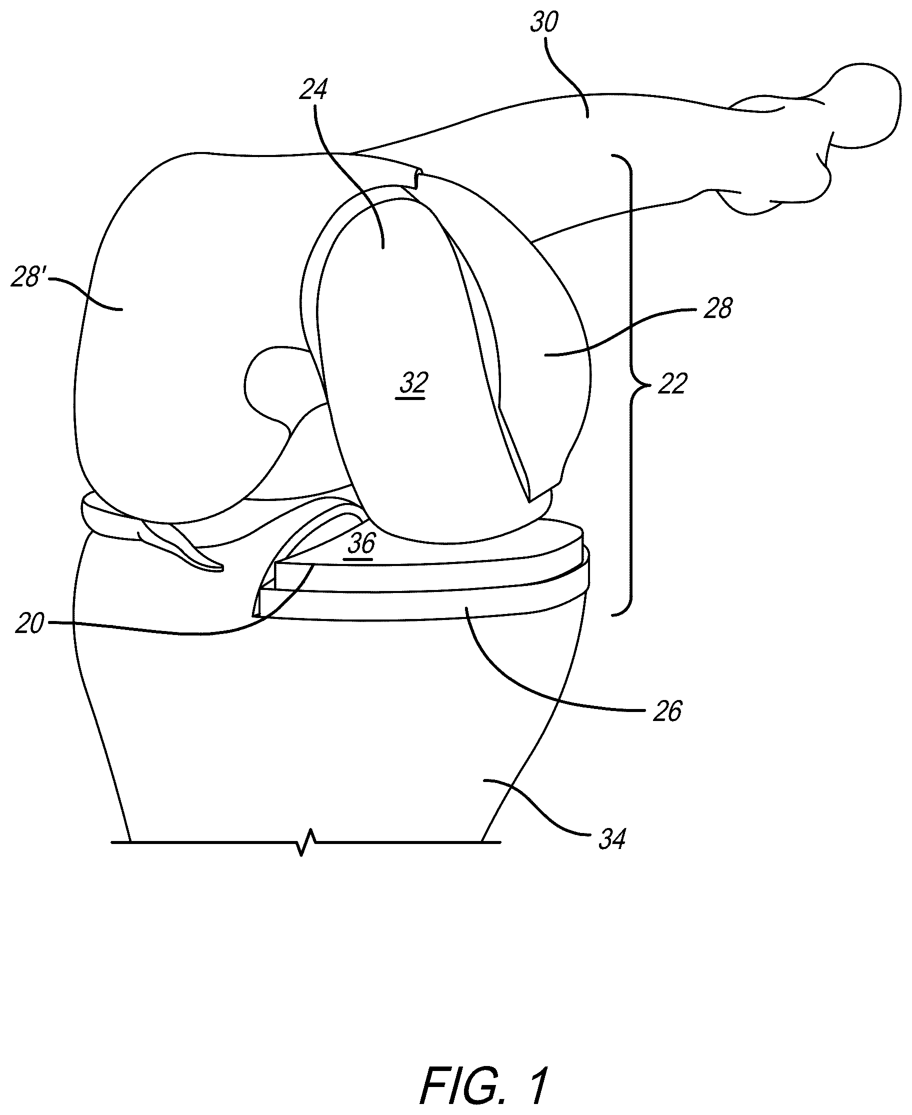 Patent US12318300 Figure 1 – Tibial insert with variable articular surface