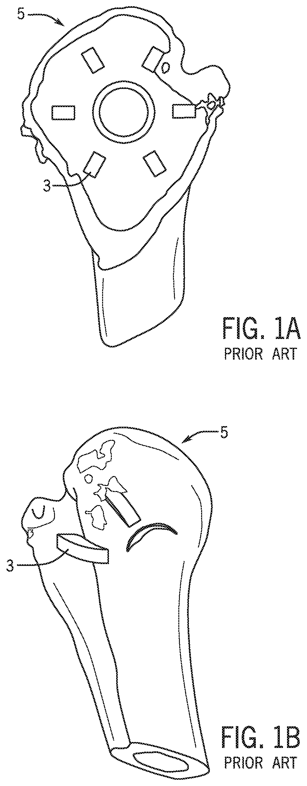 Patent US12318301 Figure 1 – Method for modeling humeral anatomy and optimization of component design