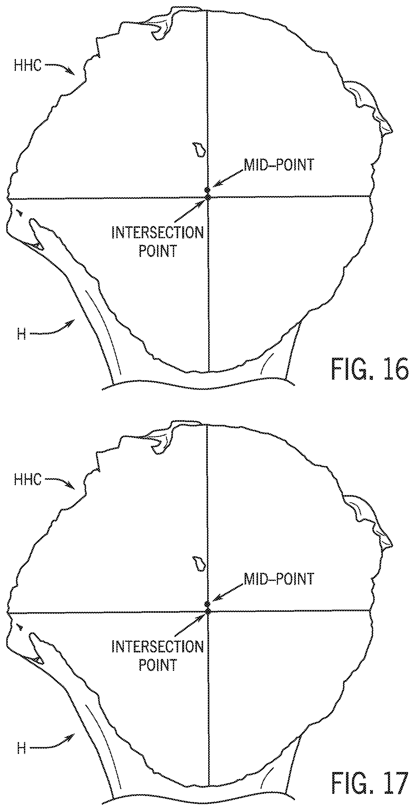 Patent US12318301 Figure 17 – Method for modeling humeral anatomy and optimization of component design