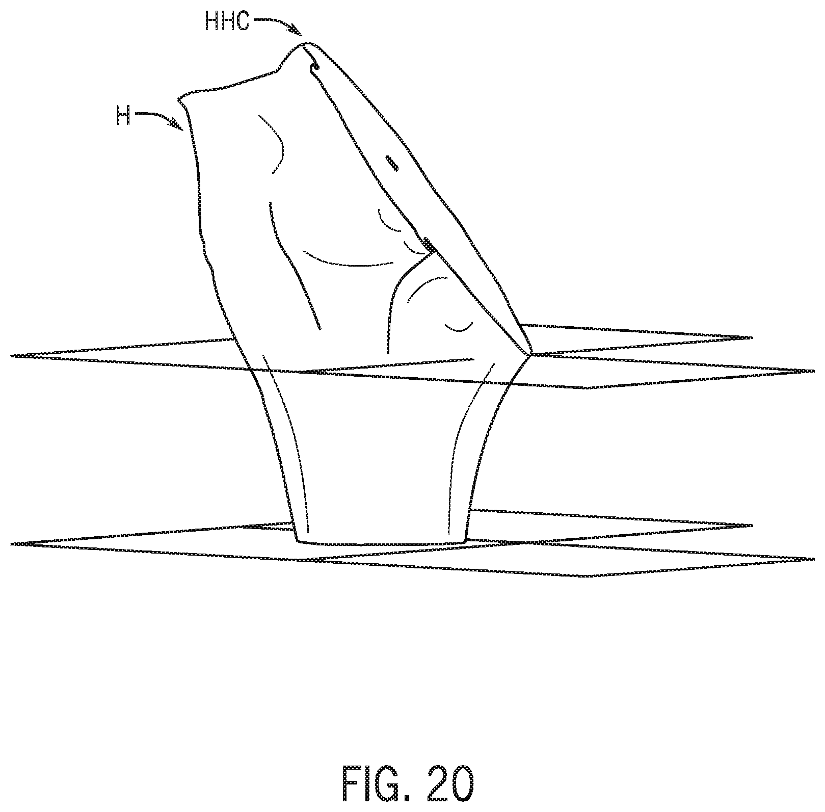 Patent US12318301 Figure 20 – Method for modeling humeral anatomy and optimization of component design