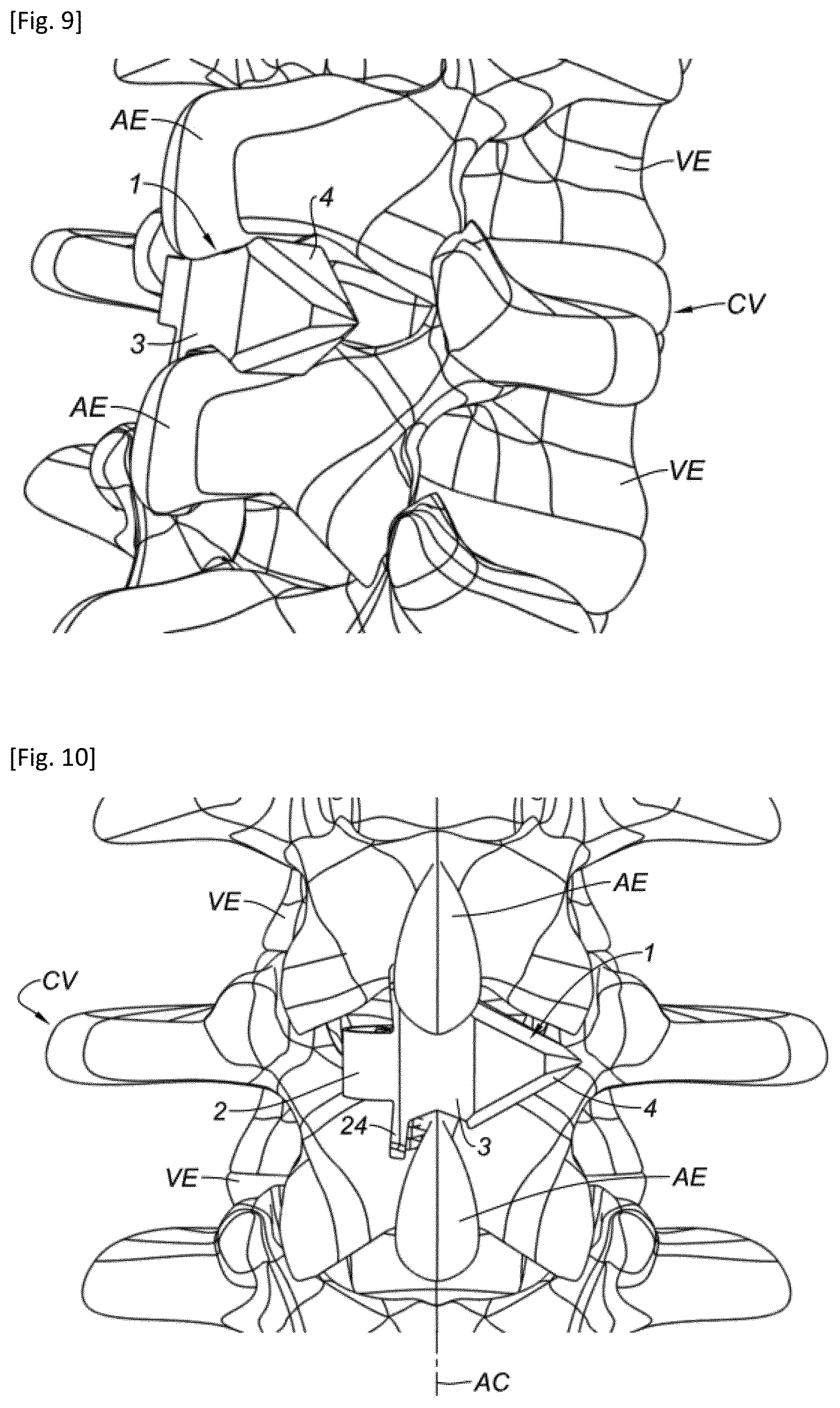 Patent US12318302 Figure 4 – Interspinous implant and associated implantation ancillary