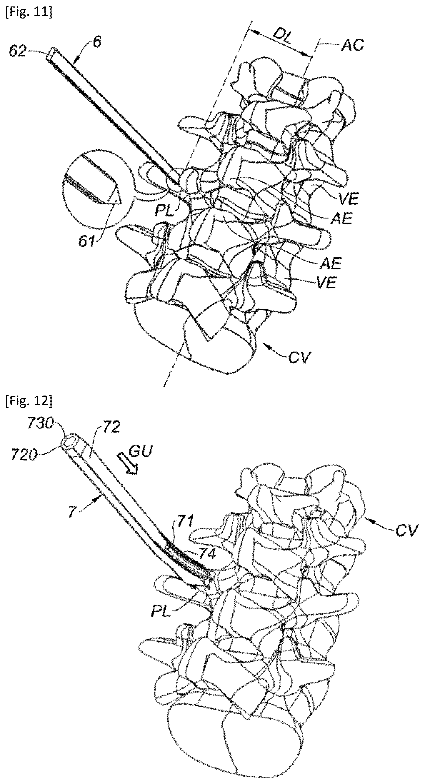 Patent US12318302 Figure 5 – Interspinous implant and associated implantation ancillary