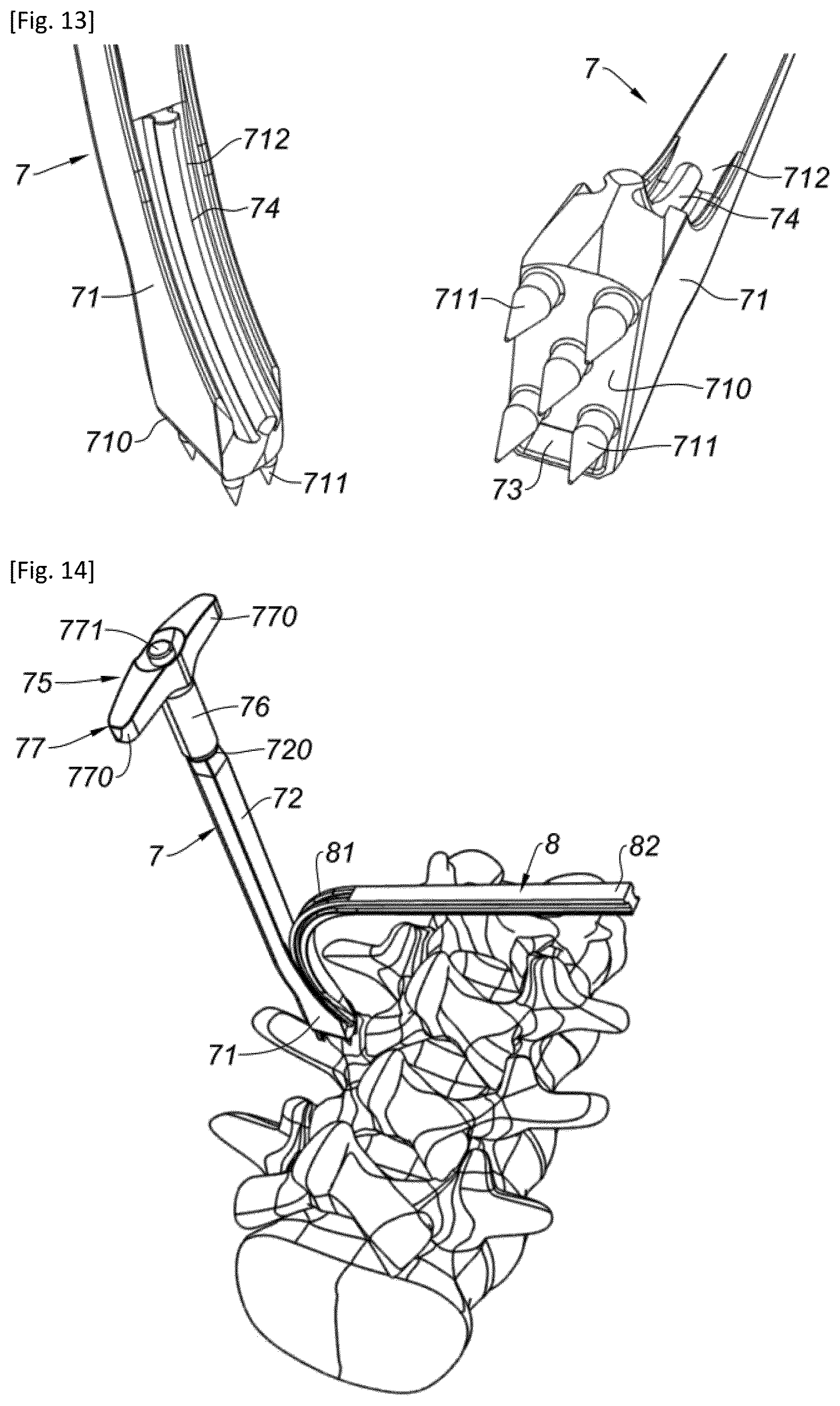 Patent US12318302 Figure 6 – Interspinous implant and associated implantation ancillary