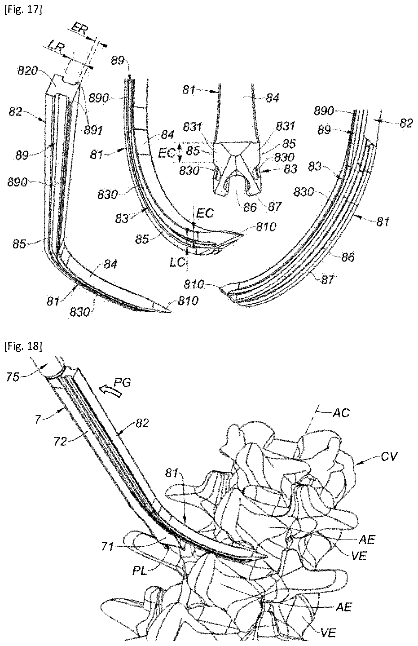 Patent US12318302 Figure 8 – Interspinous implant and associated implantation ancillary