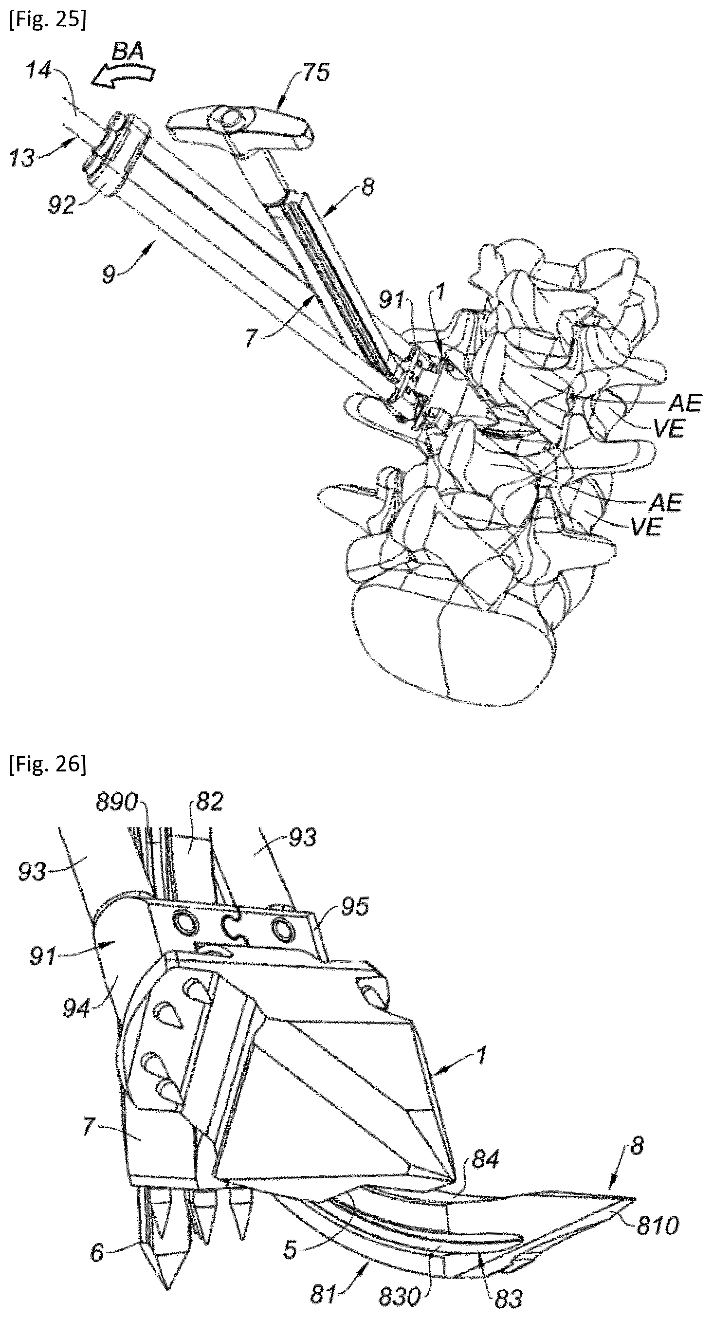 Patent US12318302 Figure 12 – Interspinous implant and associated implantation ancillary