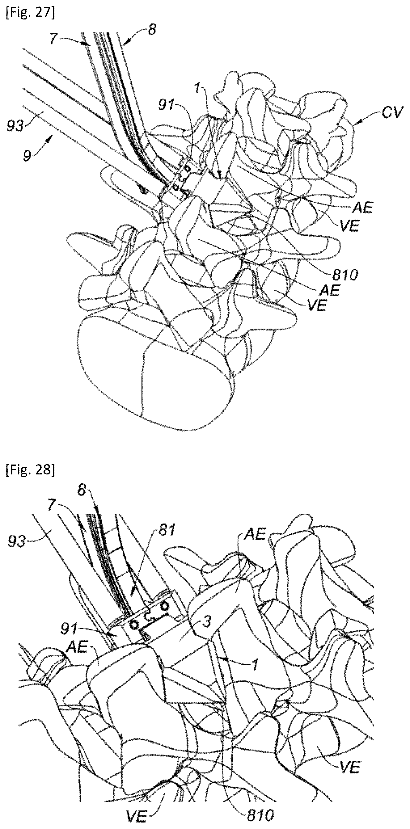 Patent US12318302 Figure 13 – Interspinous implant and associated implantation ancillary