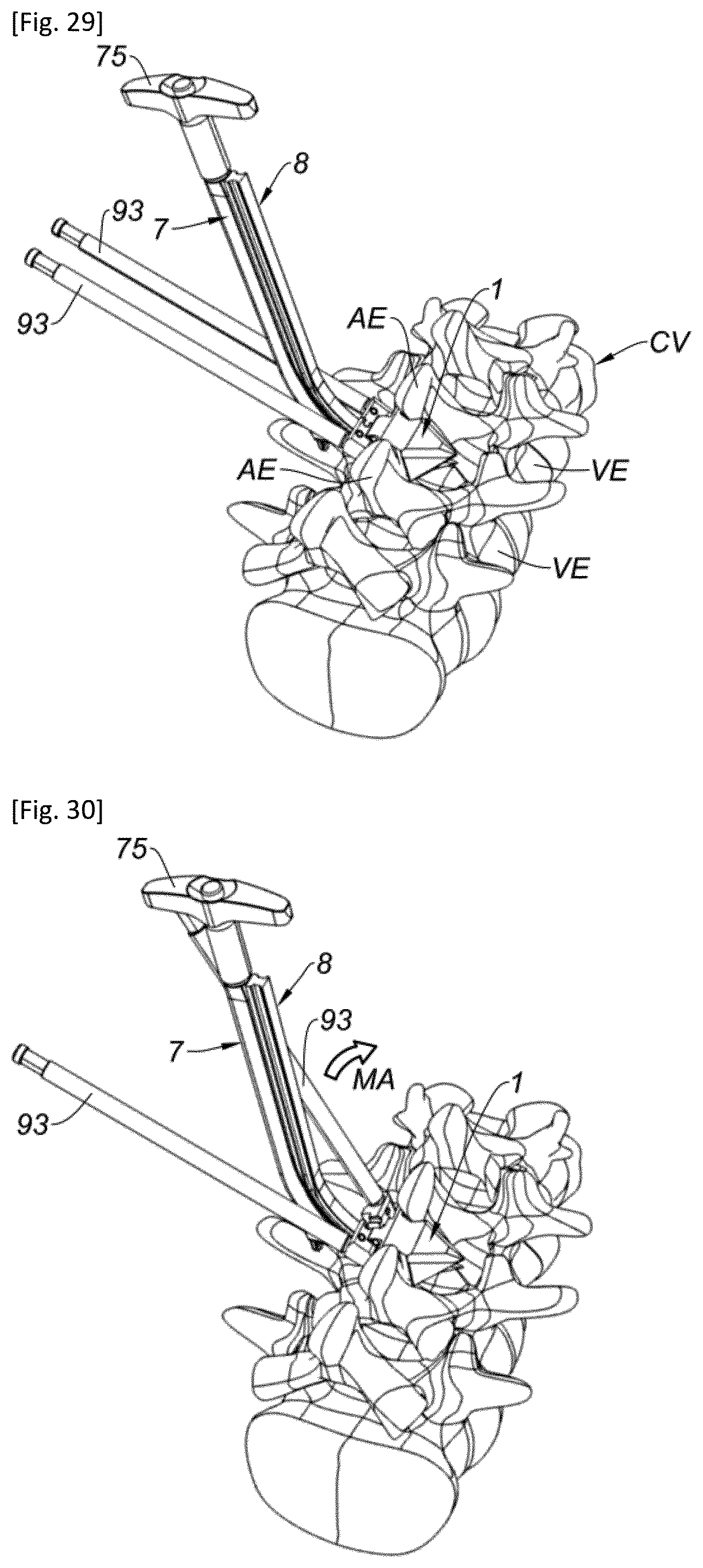Patent US12318302 Figure 14 – Interspinous implant and associated implantation ancillary