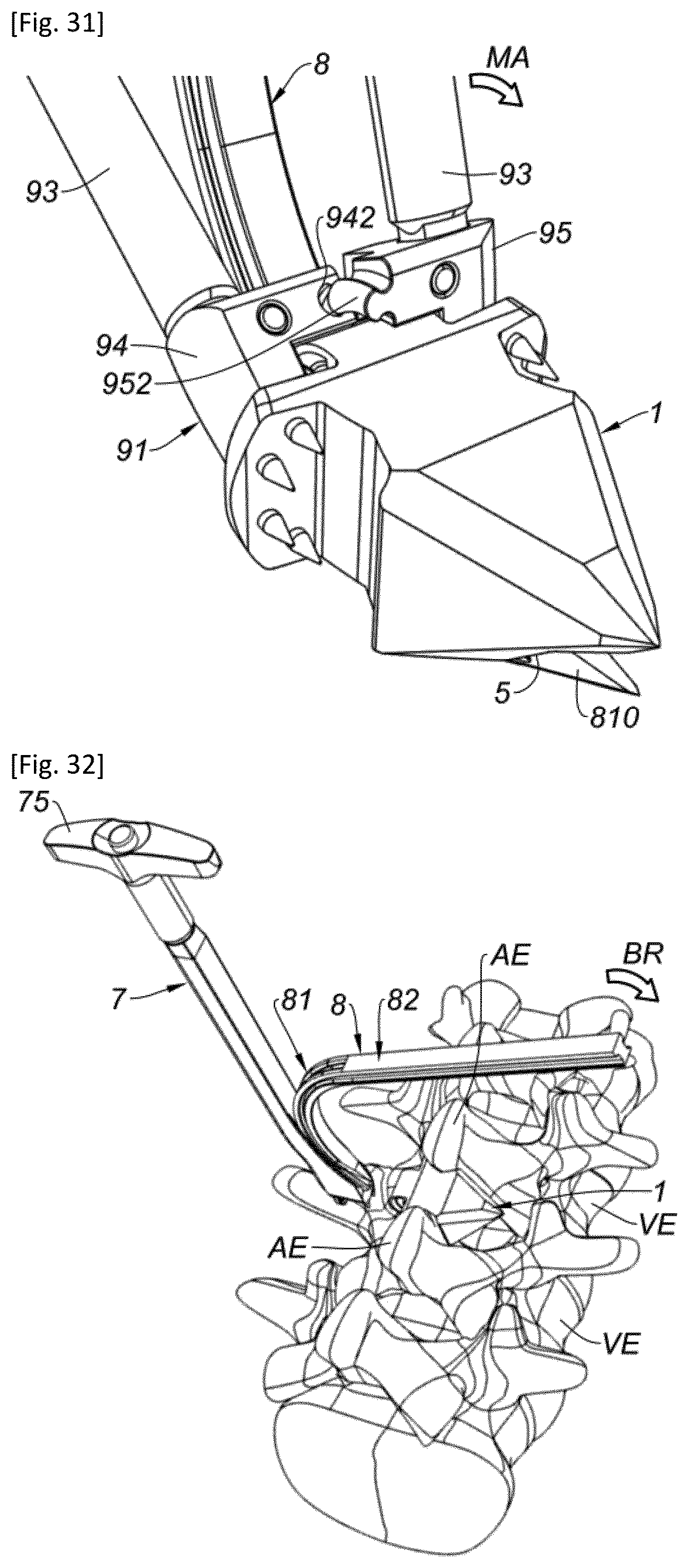 Patent US12318302 Figure 15 – Interspinous implant and associated implantation ancillary