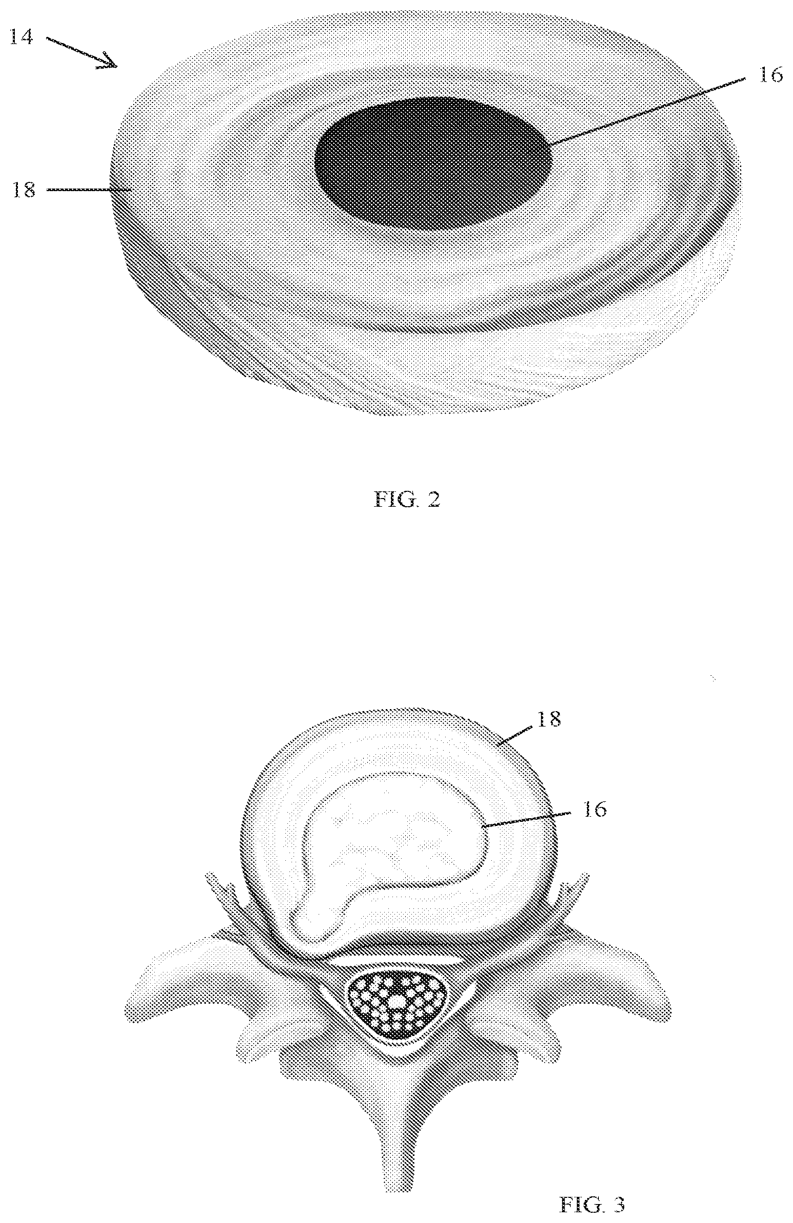 Patent US12318303 Figure 2 – Spinal disc implant and device and method for percutaneous delivery of the spinal disc implant