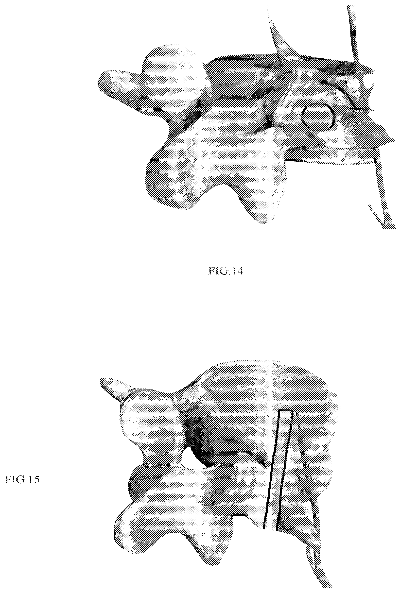 Patent US12318303 Figure 9 – Spinal disc implant and device and method for percutaneous delivery of the spinal disc implant