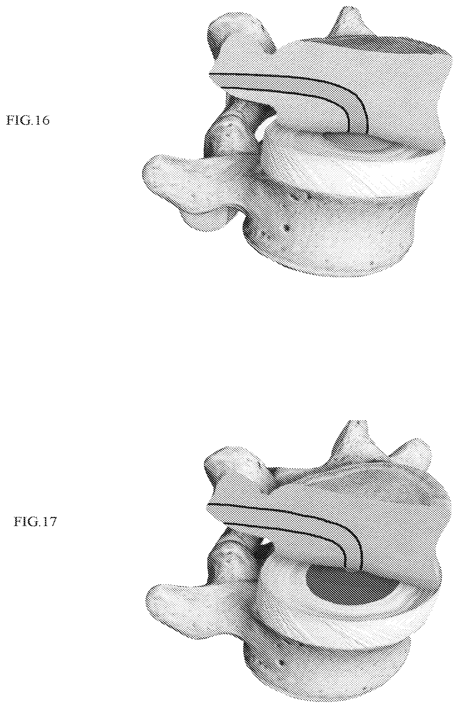 Patent US12318303 Figure 10 – Spinal disc implant and device and method for percutaneous delivery of the spinal disc implant