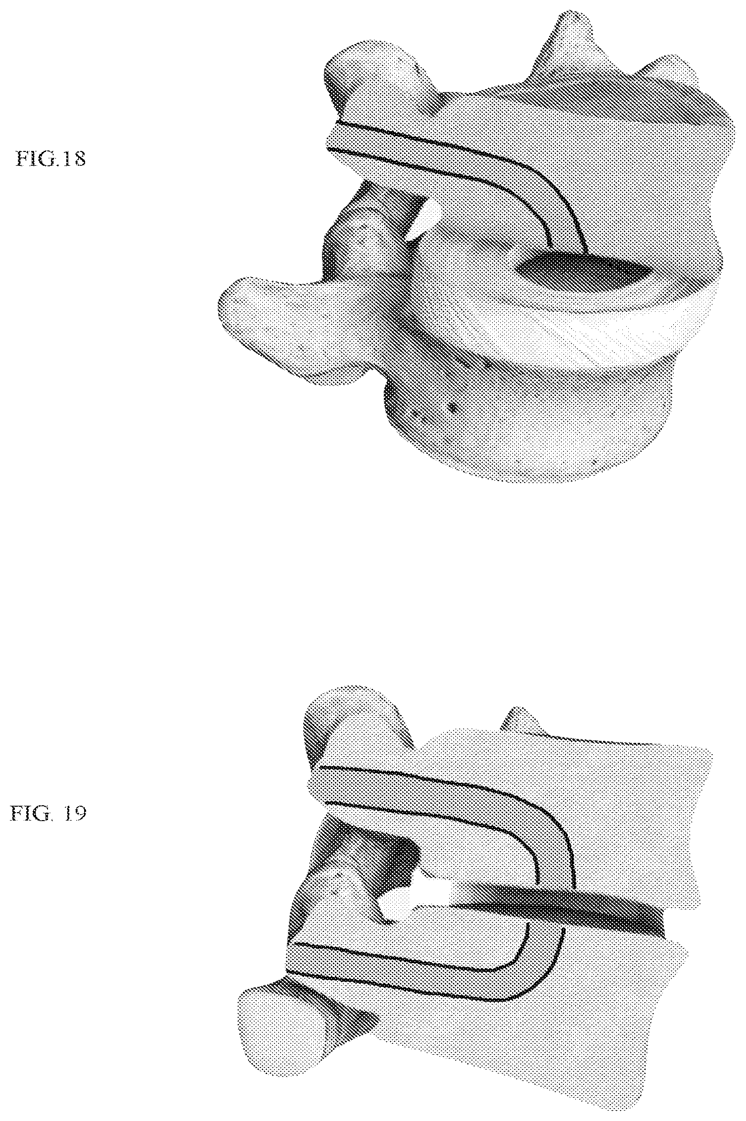 Patent US12318303 Figure 11 – Spinal disc implant and device and method for percutaneous delivery of the spinal disc implant