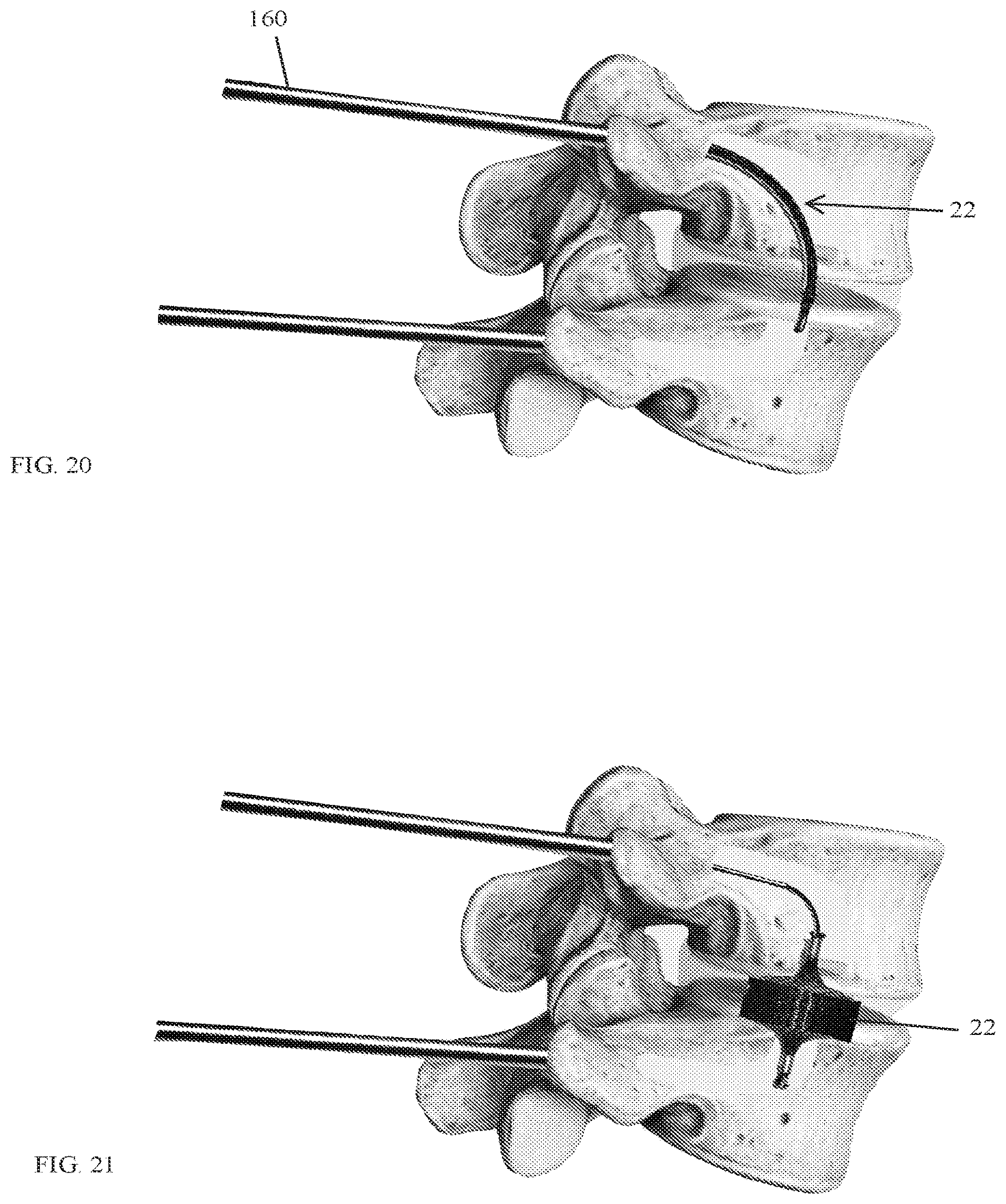 Patent US12318303 Figure 12 – Spinal disc implant and device and method for percutaneous delivery of the spinal disc implant