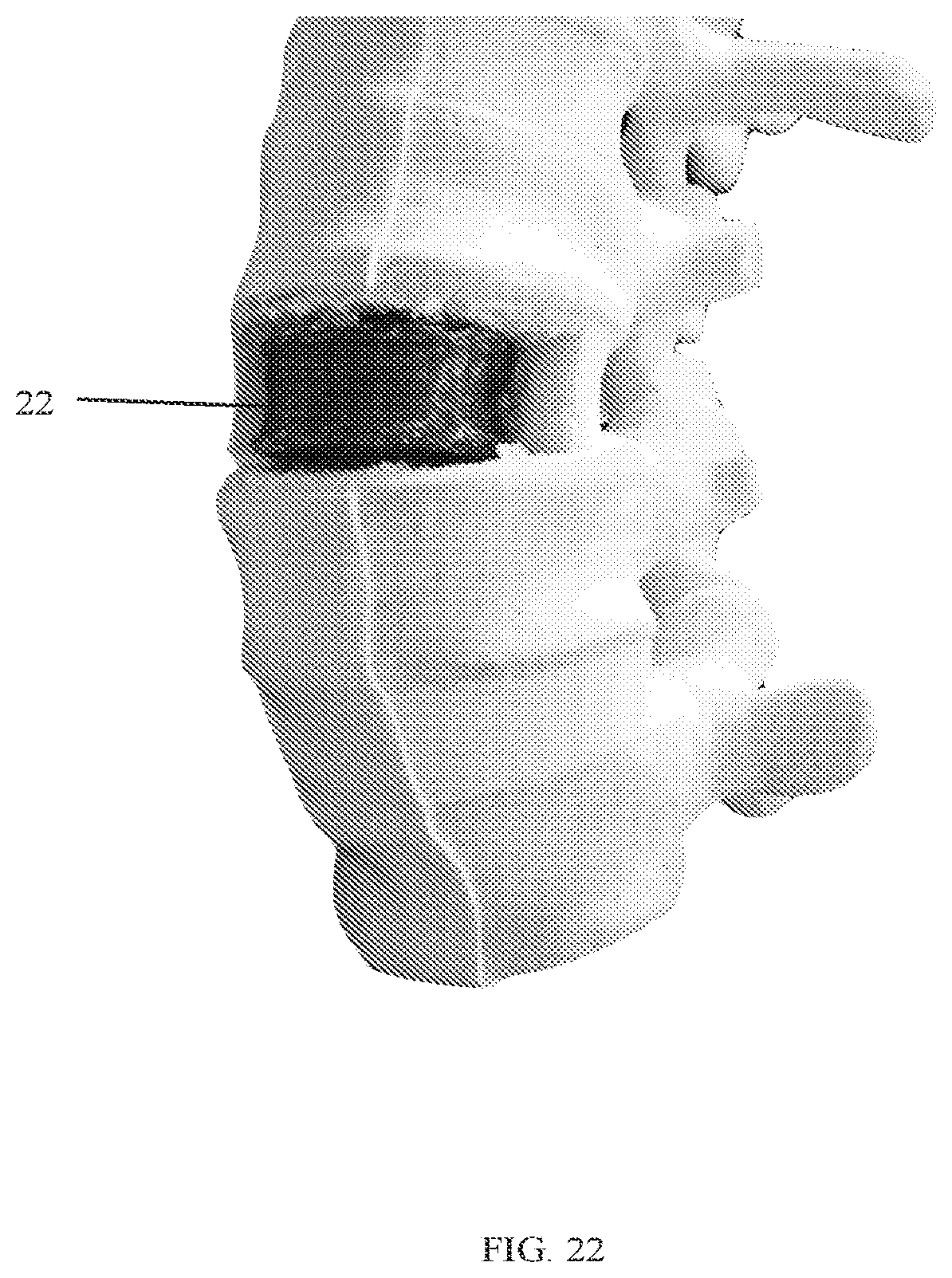Patent US12318303 Figure 13 – Spinal disc implant and device and method for percutaneous delivery of the spinal disc implant