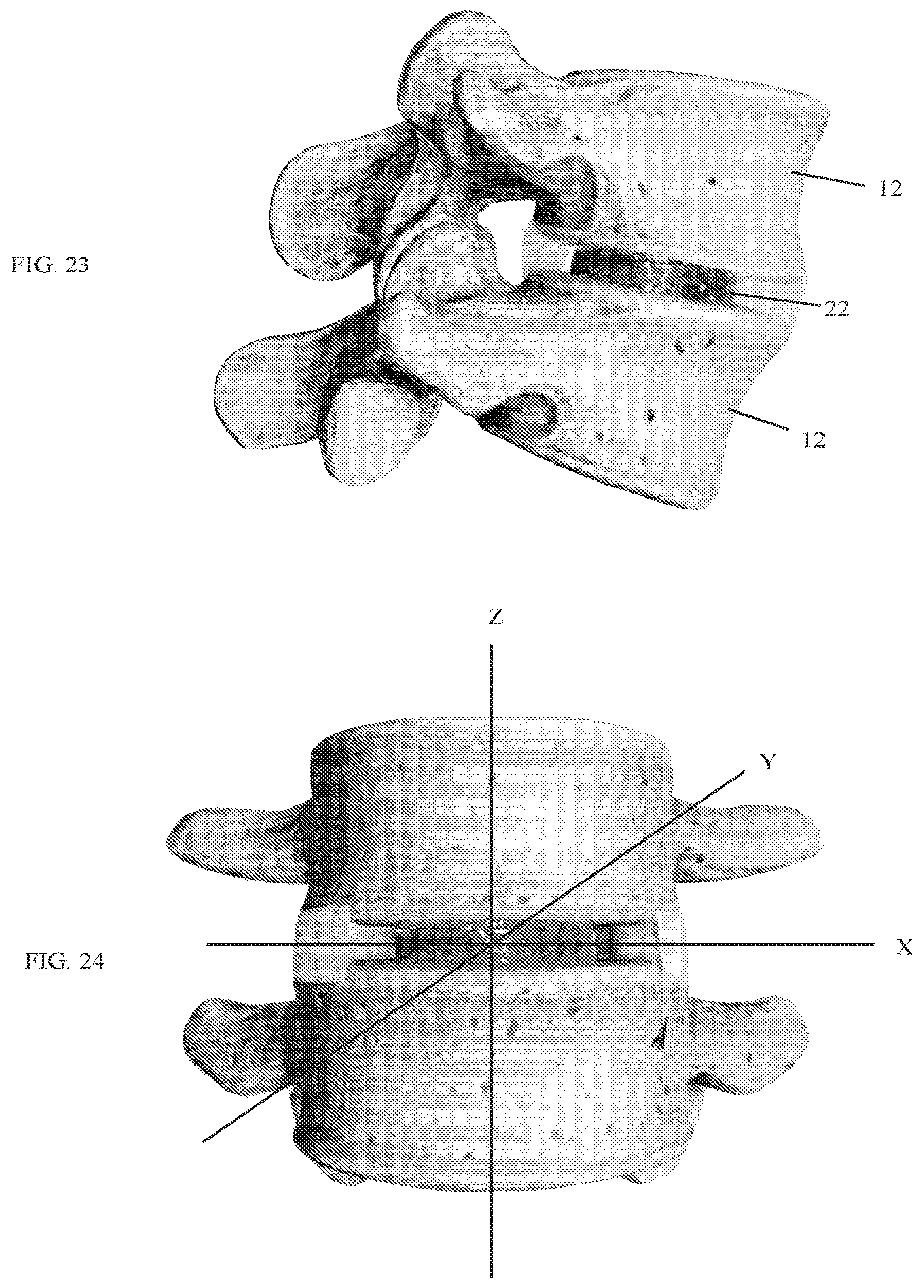 Patent US12318303 Figure 14 – Spinal disc implant and device and method for percutaneous delivery of the spinal disc implant