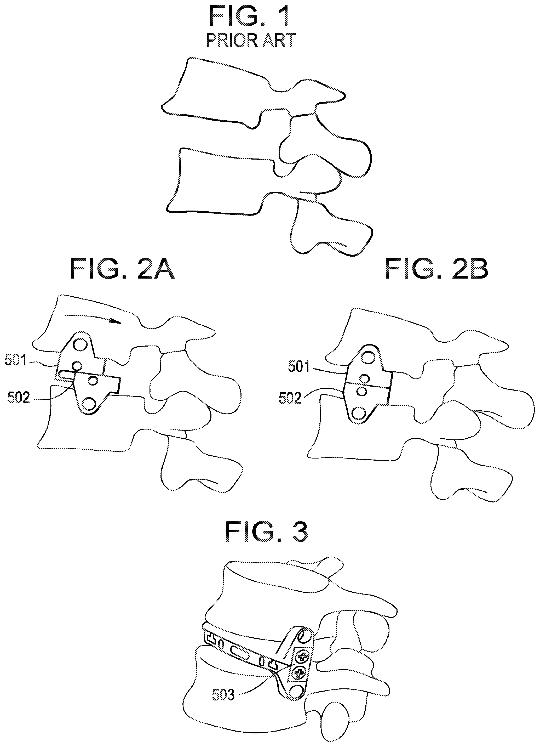 Patent US12318304 Figure 1 – Lateral spondylolisthesis reduction cage