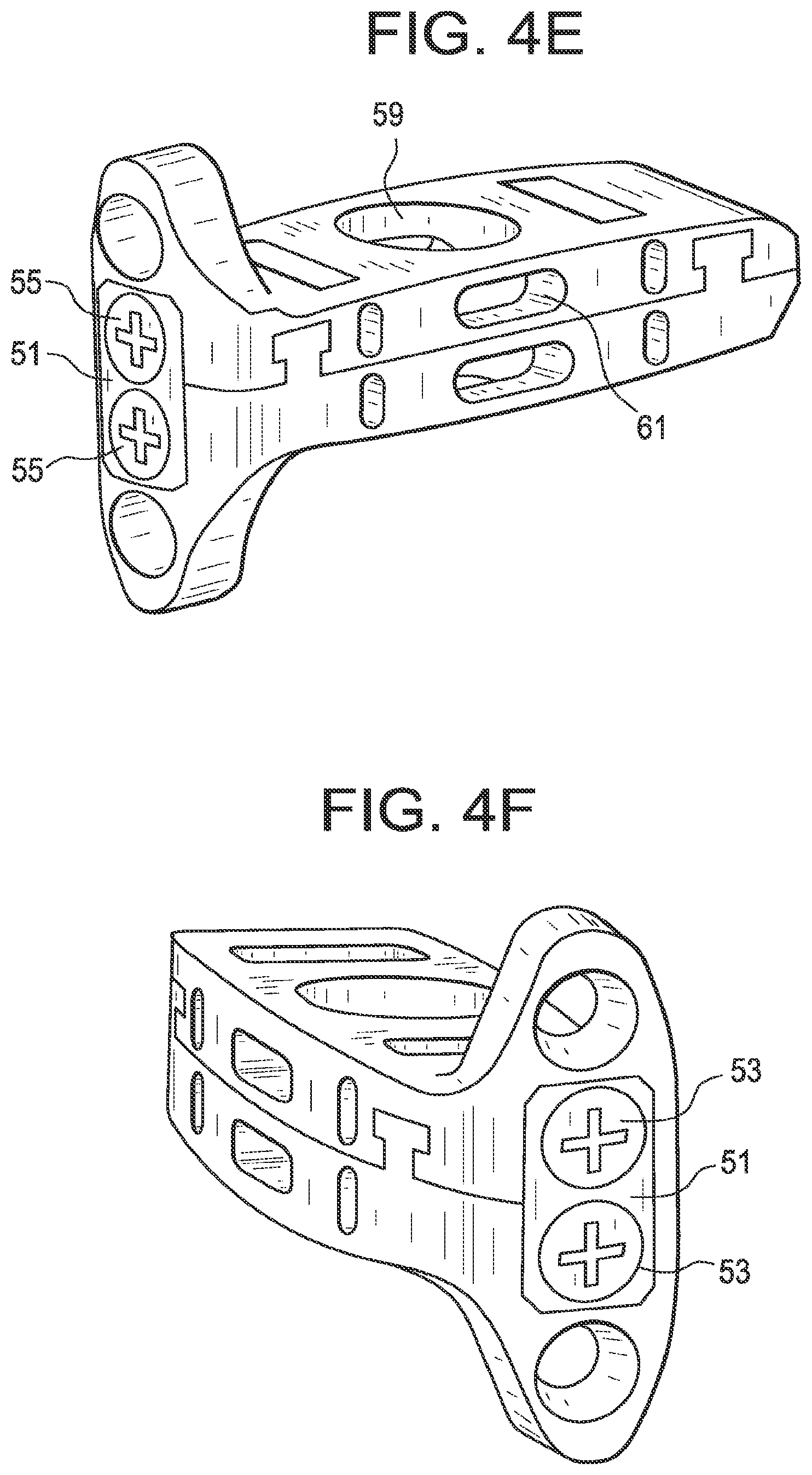 Patent US12318304 Figure 3 – Lateral spondylolisthesis reduction cage
