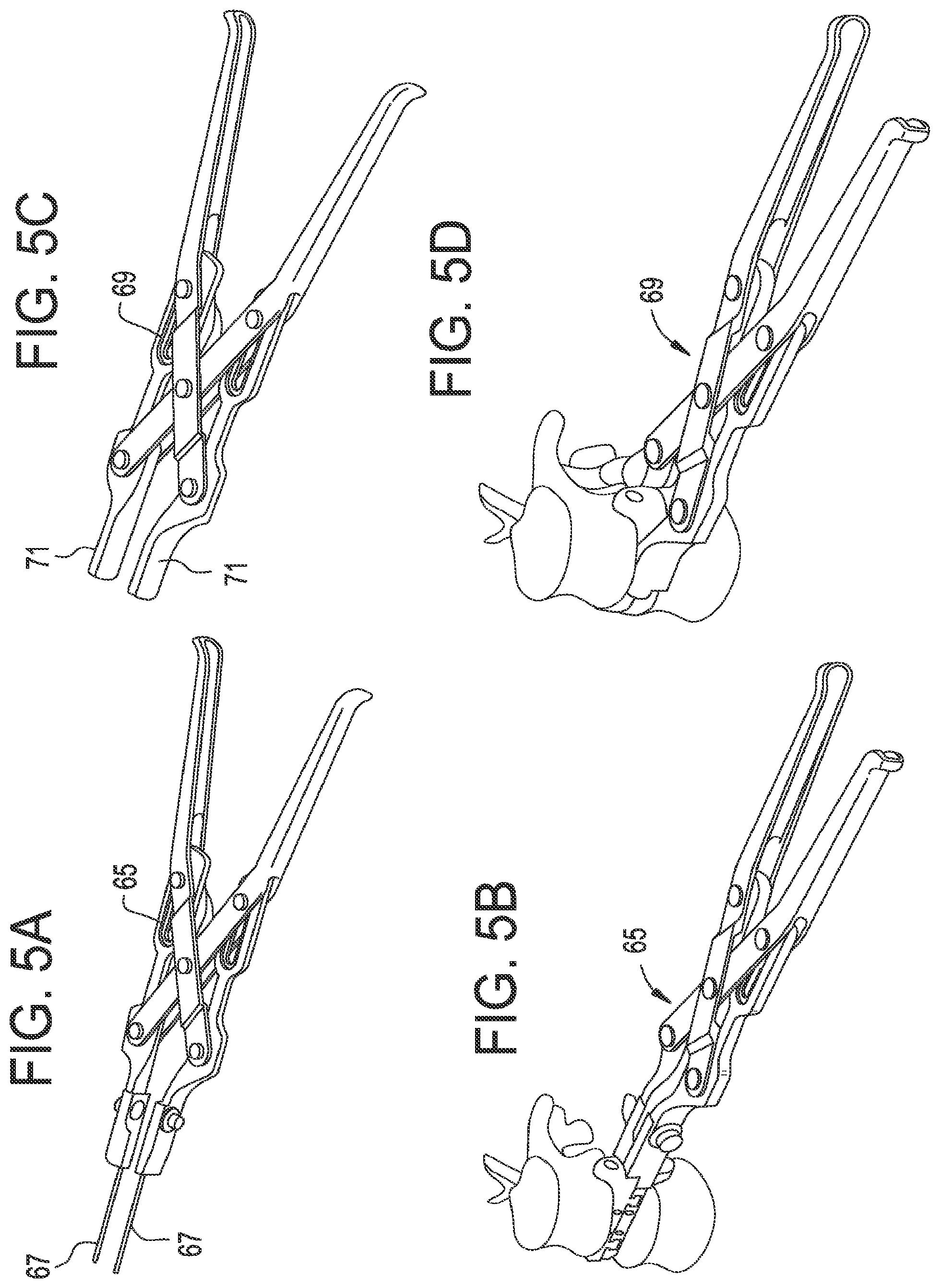 Patent US12318304 Figure 4 – Lateral spondylolisthesis reduction cage