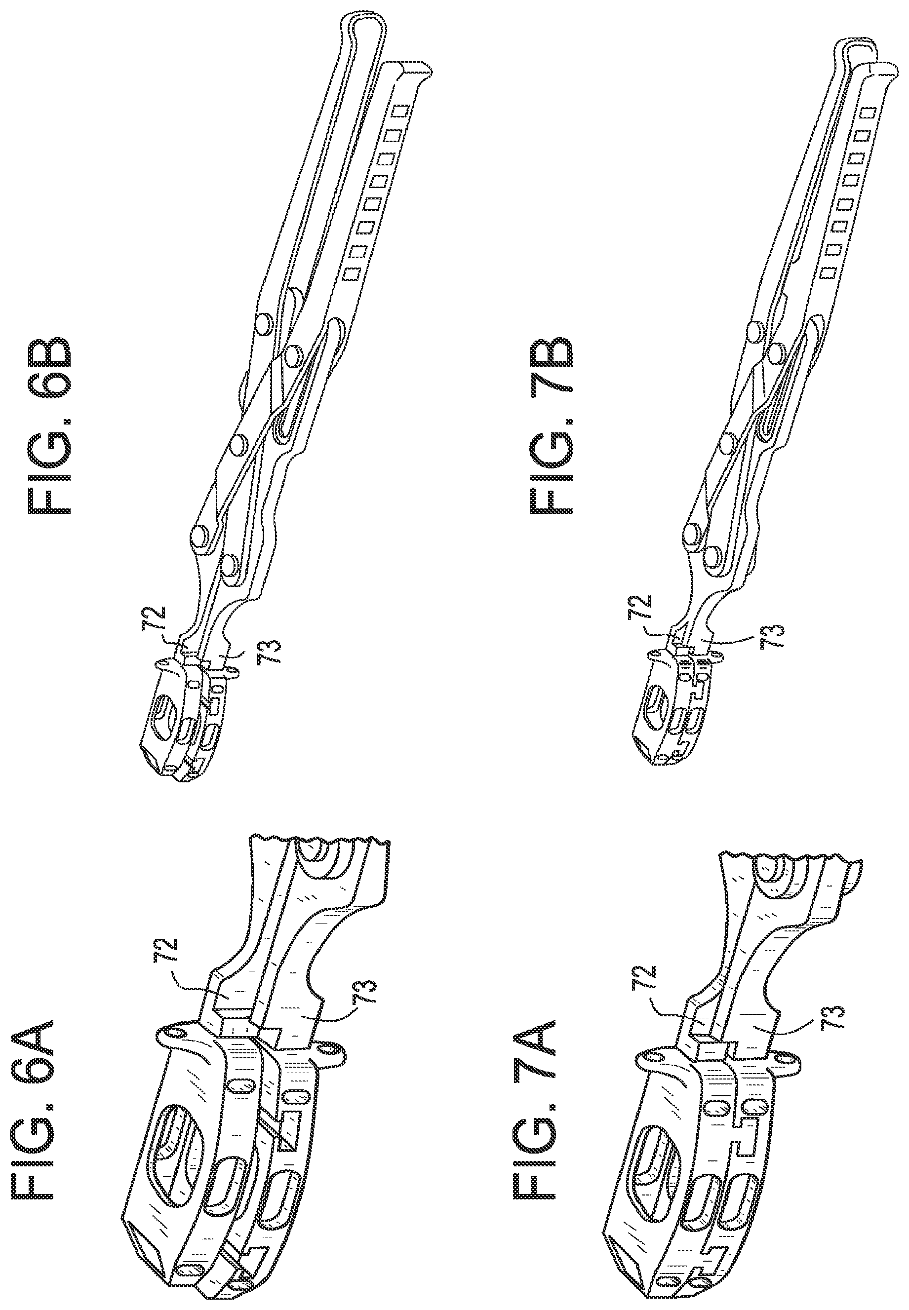 Patent US12318304 Figure 5 – Lateral spondylolisthesis reduction cage
