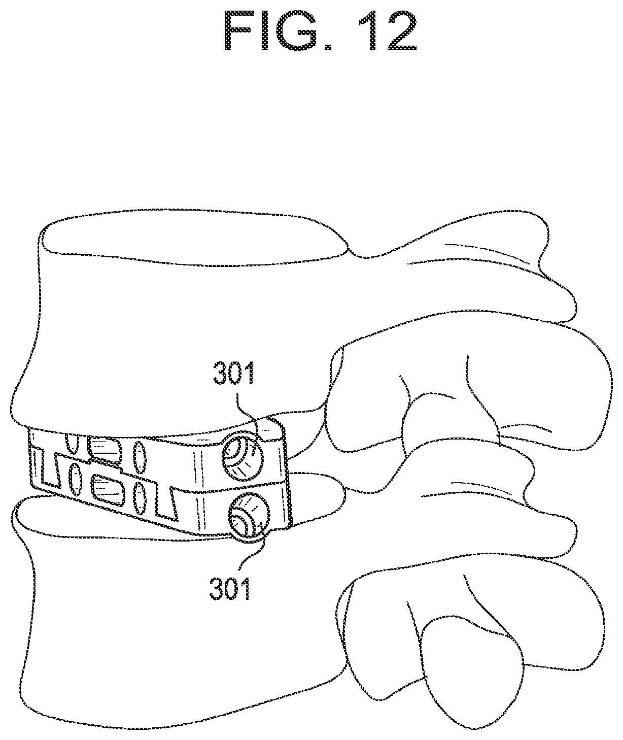 Patent US12318304 Figure 11 – Lateral spondylolisthesis reduction cage