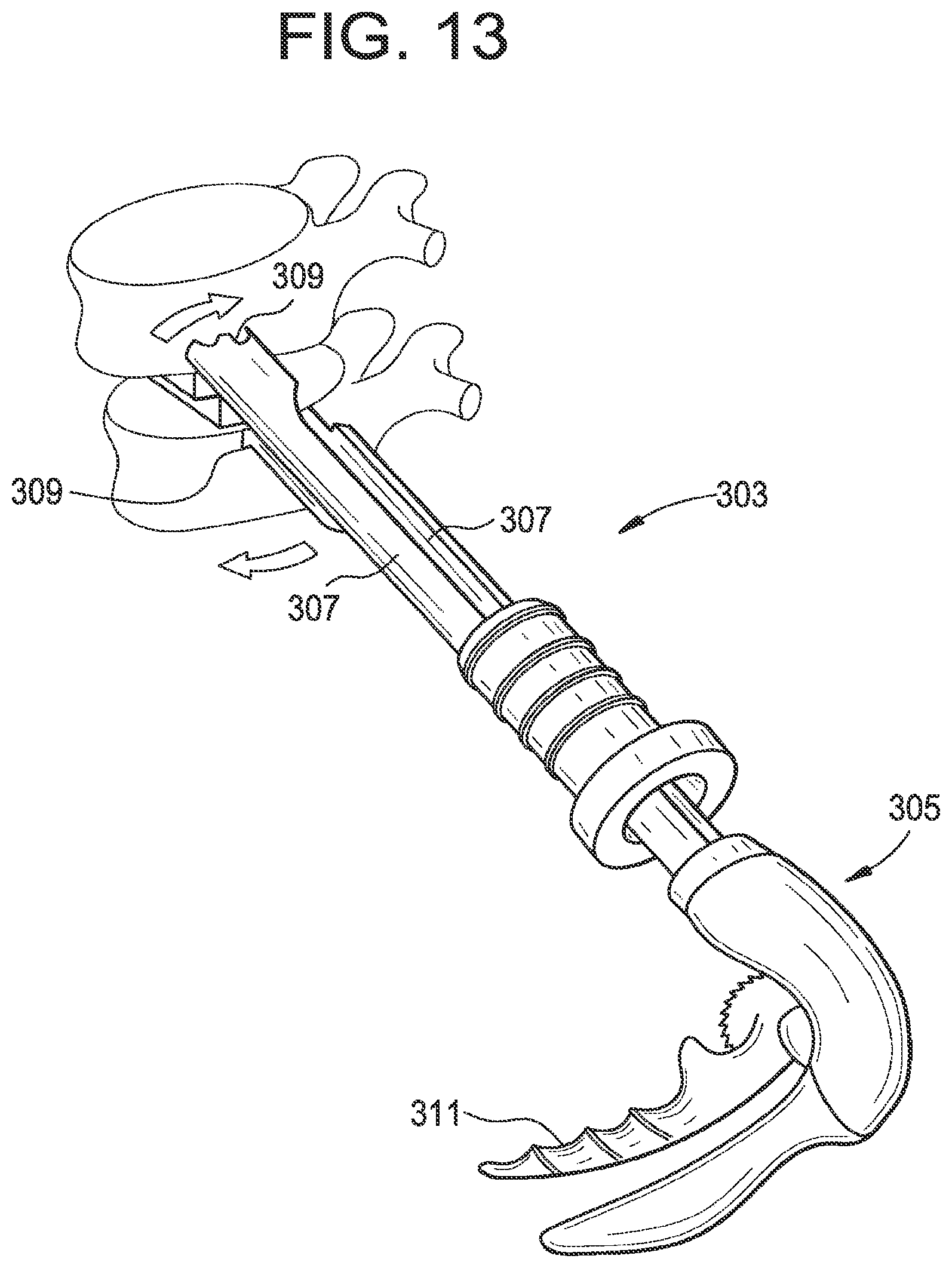 Patent US12318304 Figure 12 – Lateral spondylolisthesis reduction cage