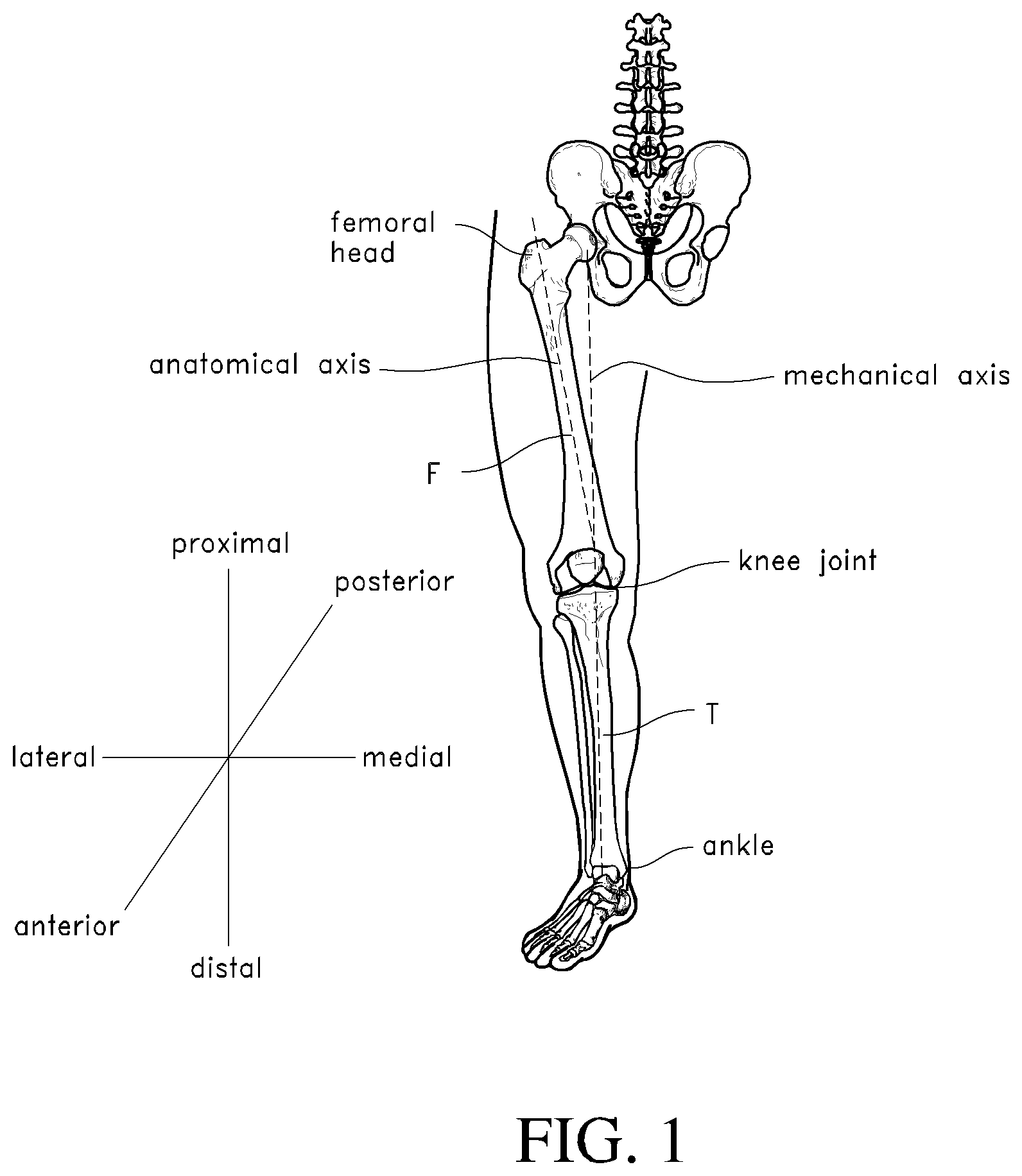 Patent US12318313 Figure 1 – Systems and methods for joint replacement