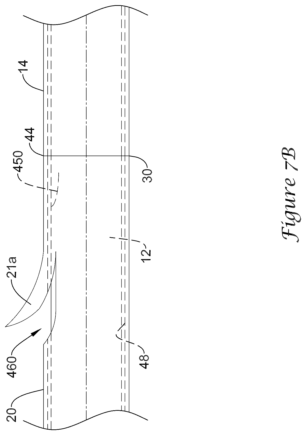 Patent US12318317 Figure 17 – Stent delivery system having retention structure