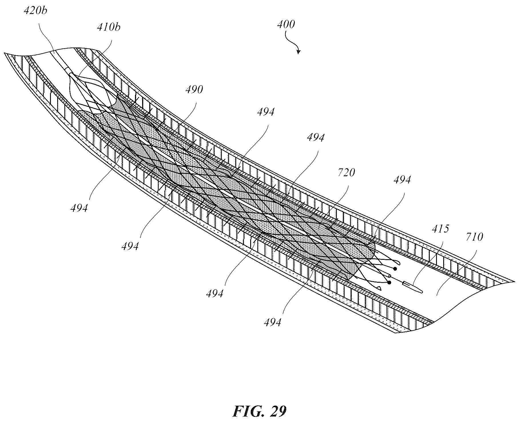 Patent US12318318 Figure 15 – Delivery systems for stents having protruding features