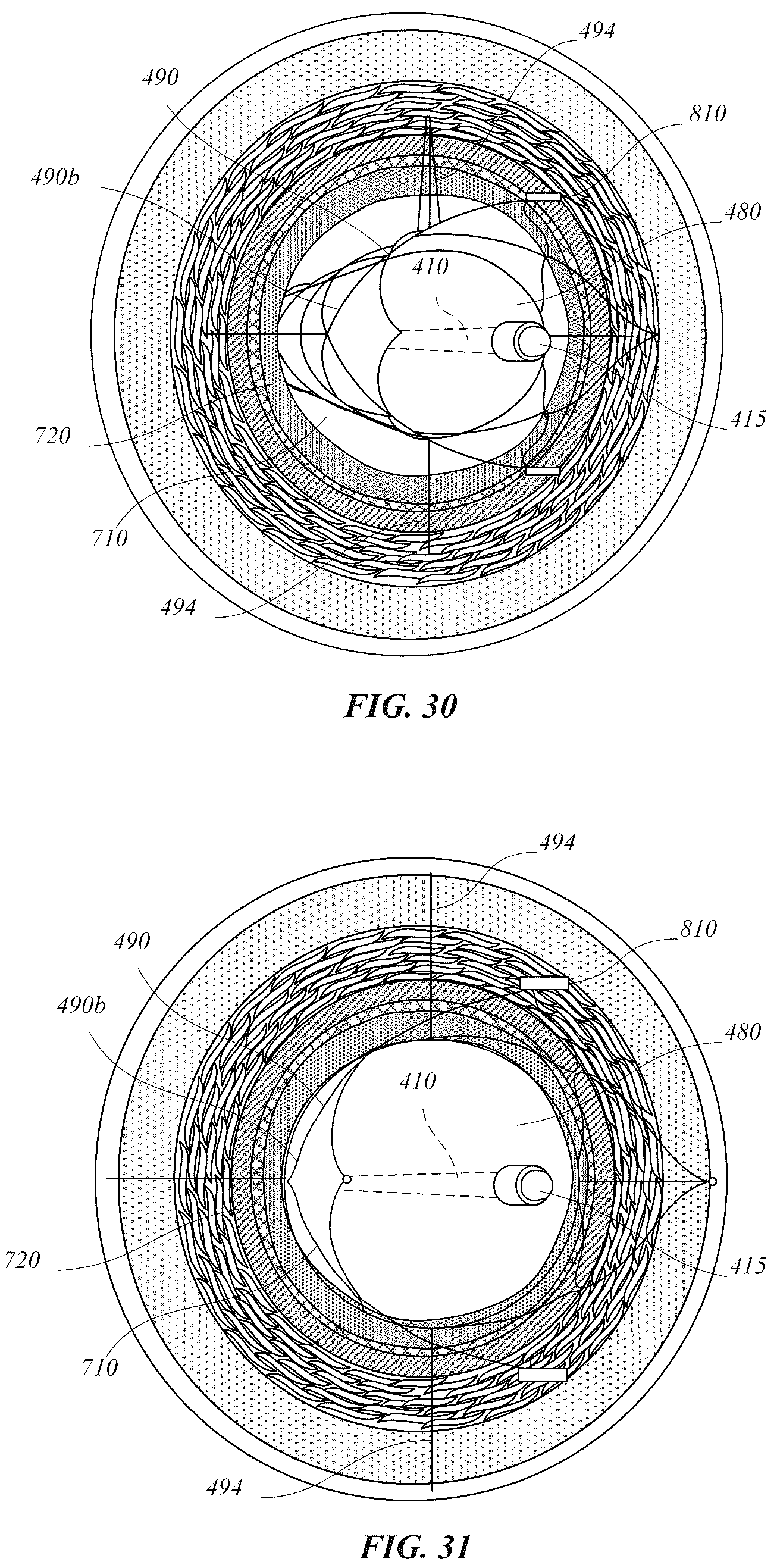 Patent US12318318 Figure 16 – Delivery systems for stents having protruding features