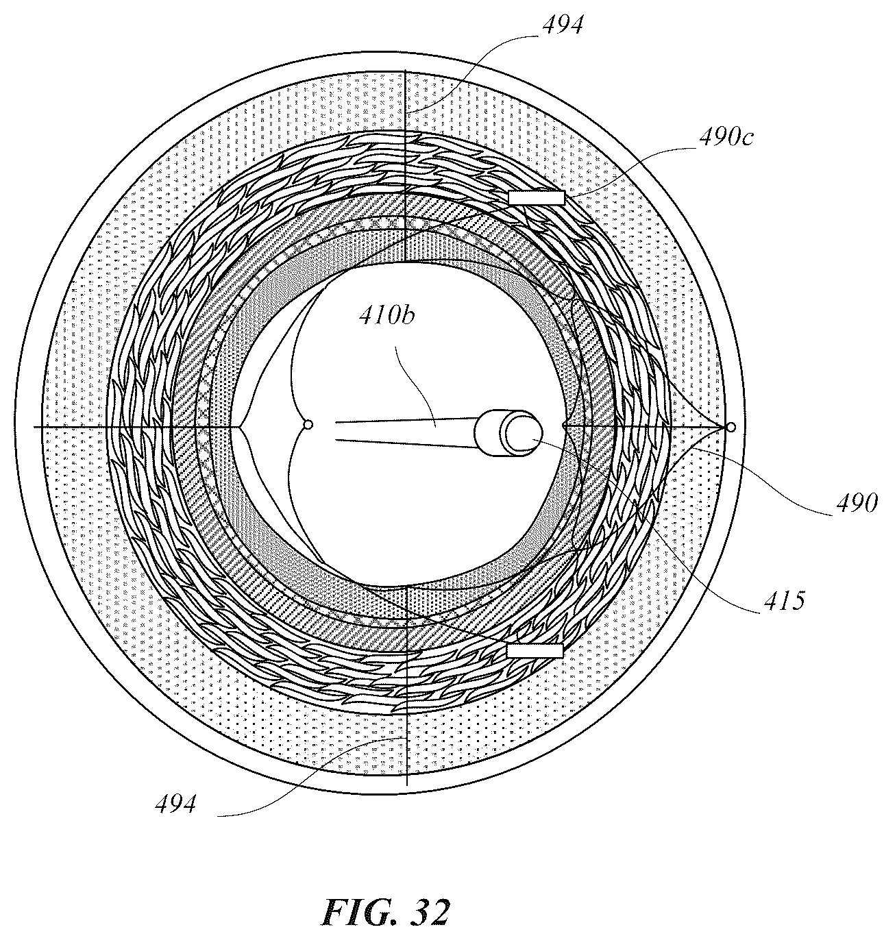 Patent US12318318 Figure 17 – Delivery systems for stents having protruding features