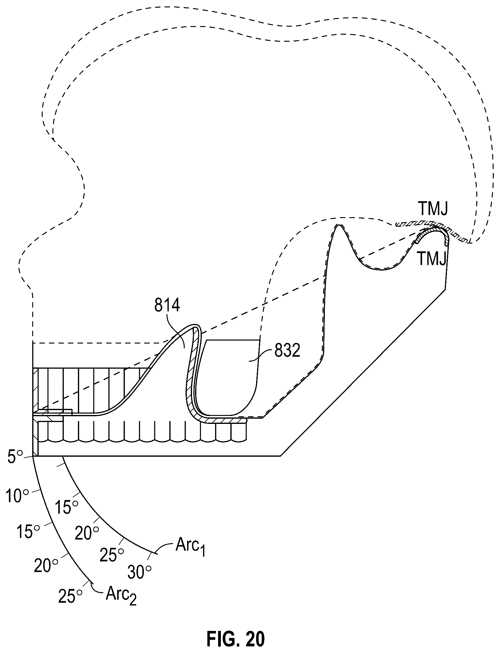 Patent US12318325 Figure 12 – Maxillary and mandibular devices that prevent disengagement therebetween, controller station, and methods of treating and/or diagnosing medical disorders