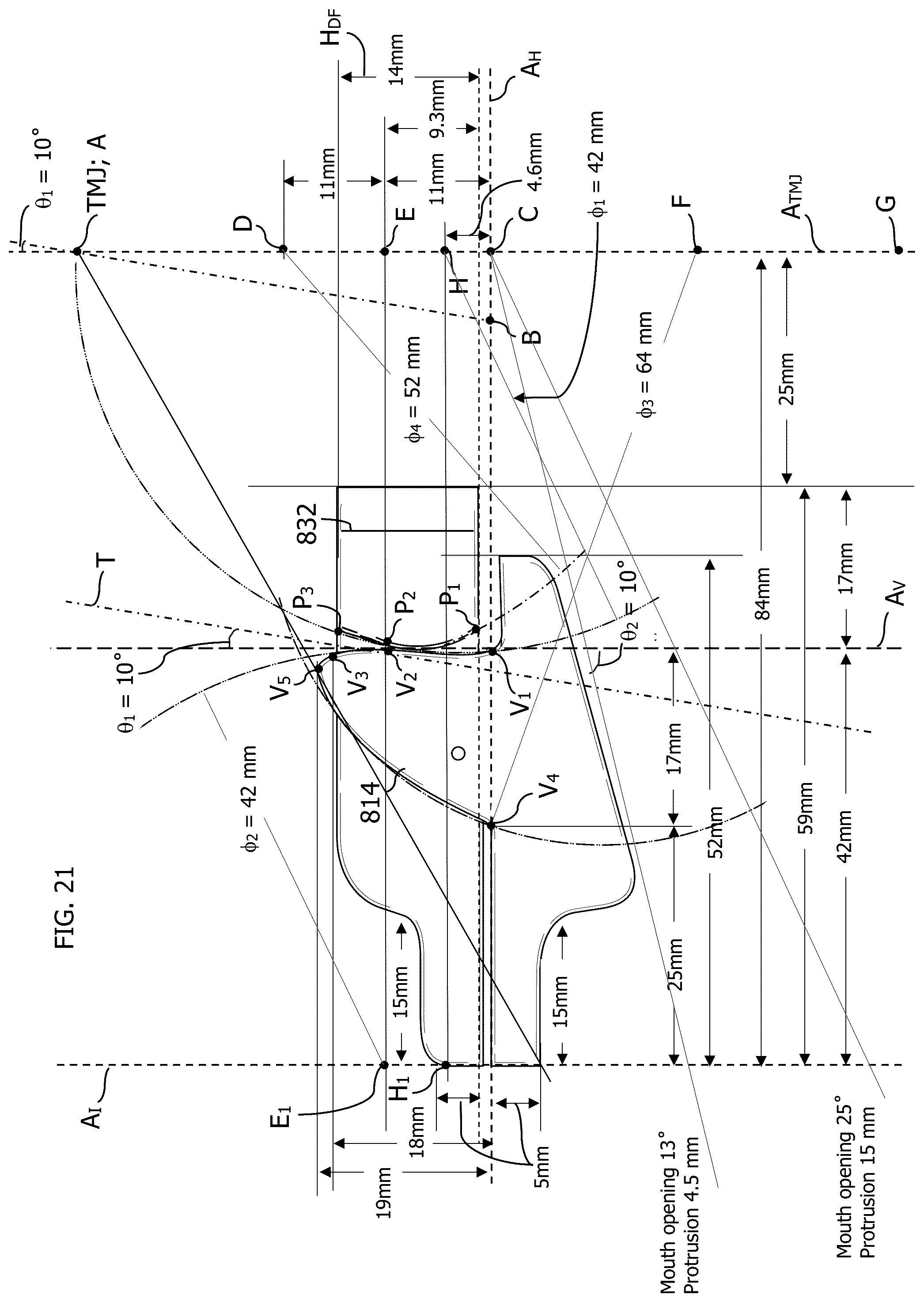 Patent US12318325 Figure 13 – Maxillary and mandibular devices that prevent disengagement therebetween, controller station, and methods of treating and/or diagnosing medical disorders