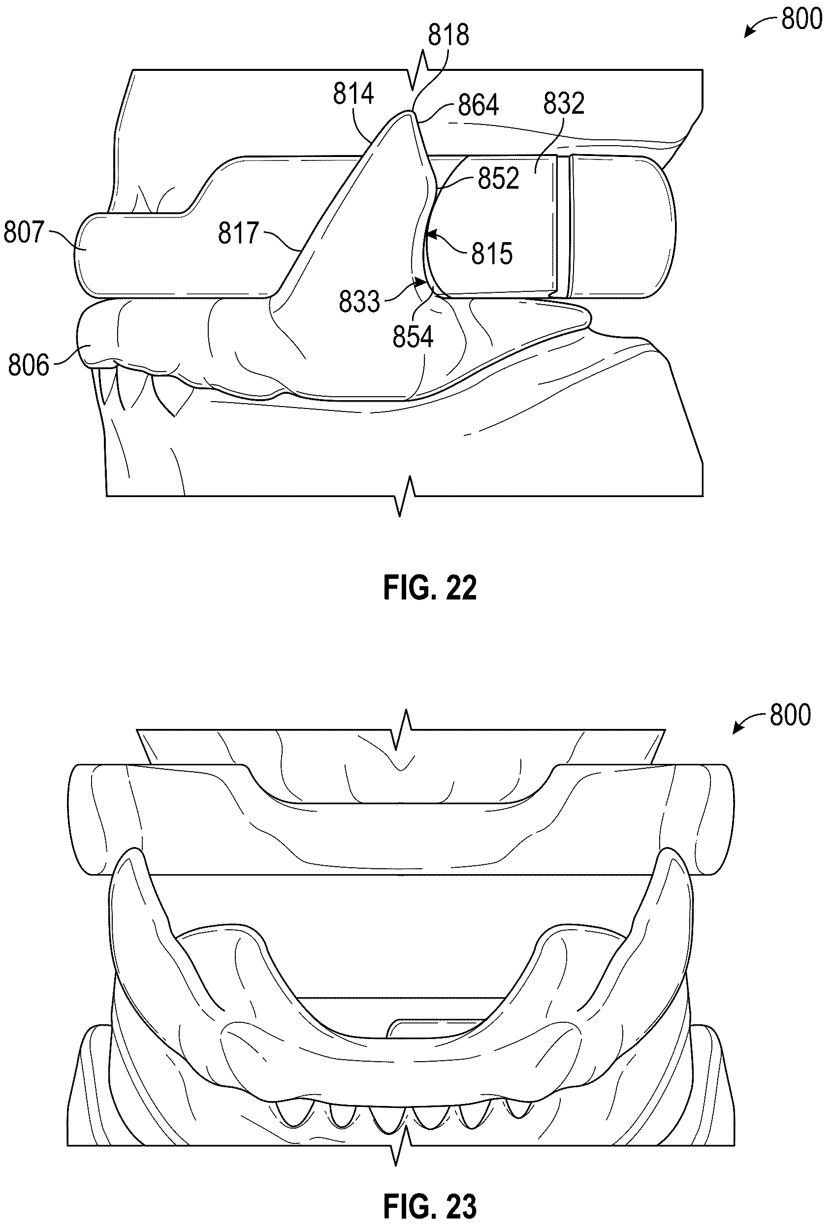 Patent US12318325 Figure 14 – Maxillary and mandibular devices that prevent disengagement therebetween, controller station, and methods of treating and/or diagnosing medical disorders