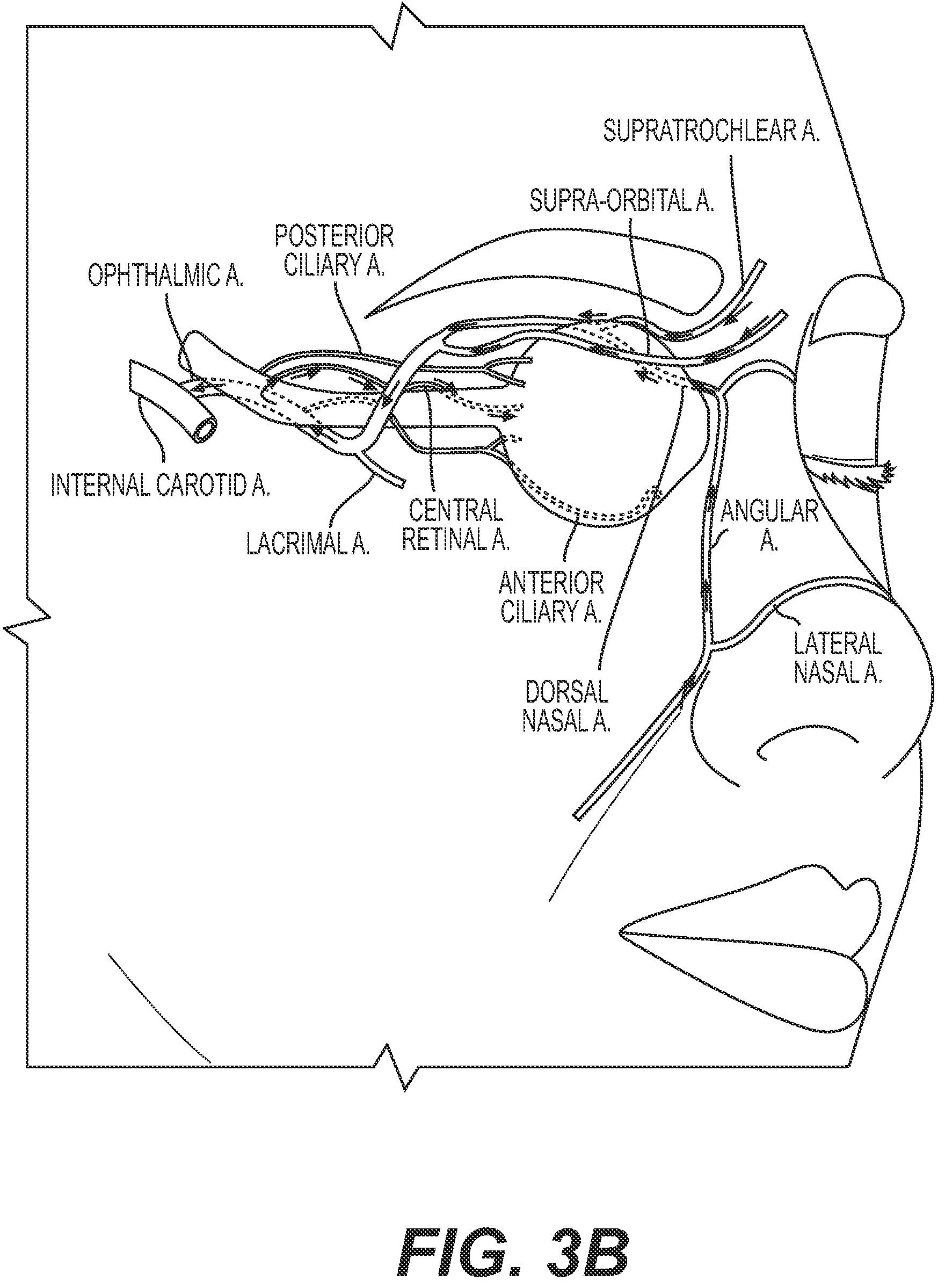 Patent US12318327 Figure 4 – Systems and methods for treating eye diseases