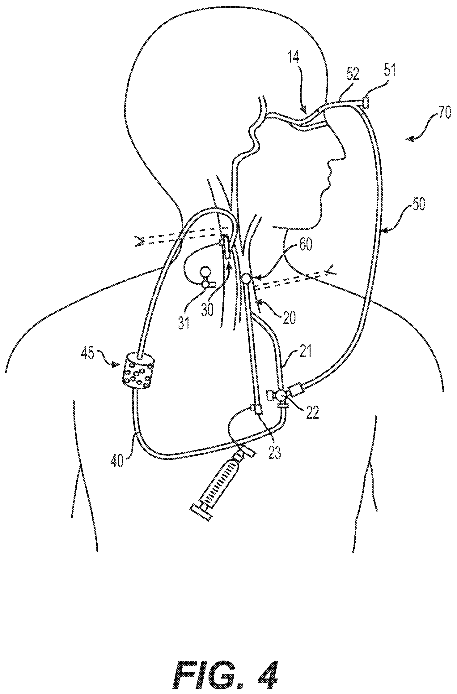 Patent US12318327 Figure 5 – Systems and methods for treating eye diseases