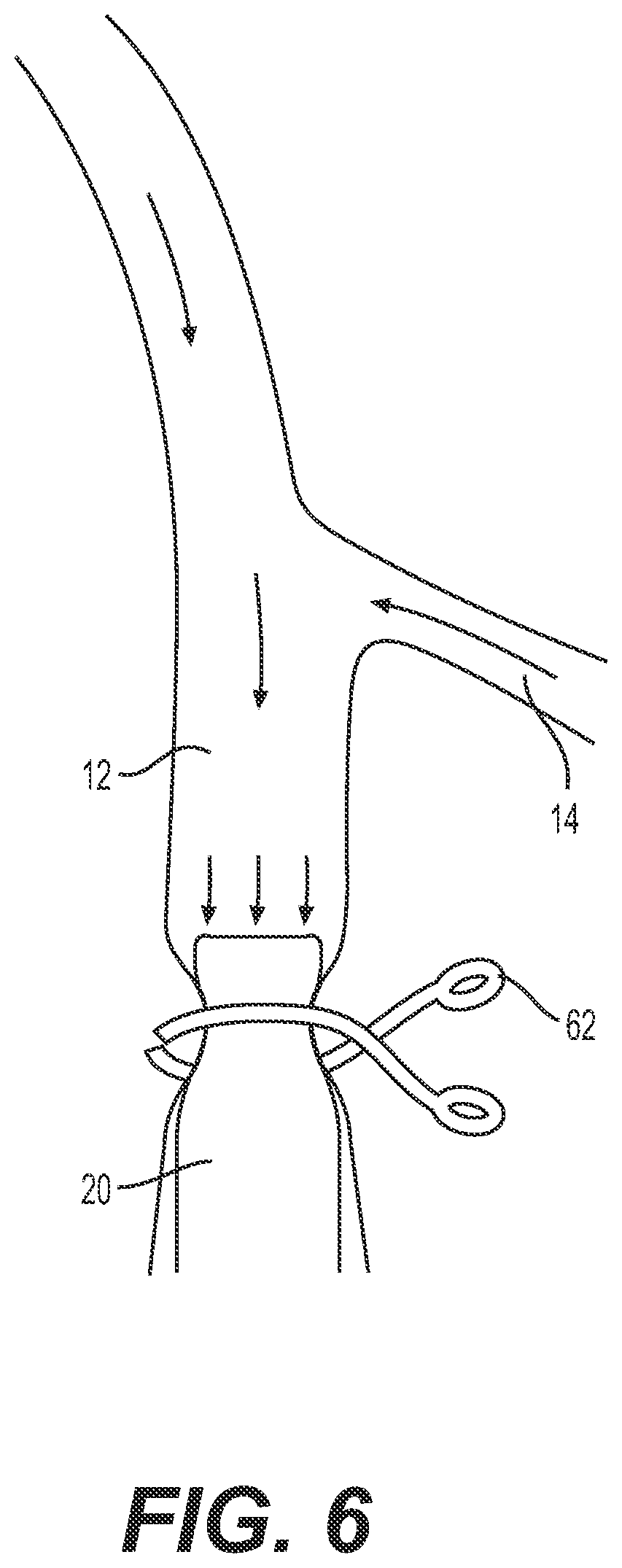 Patent US12318327 Figure 7 – Systems and methods for treating eye diseases