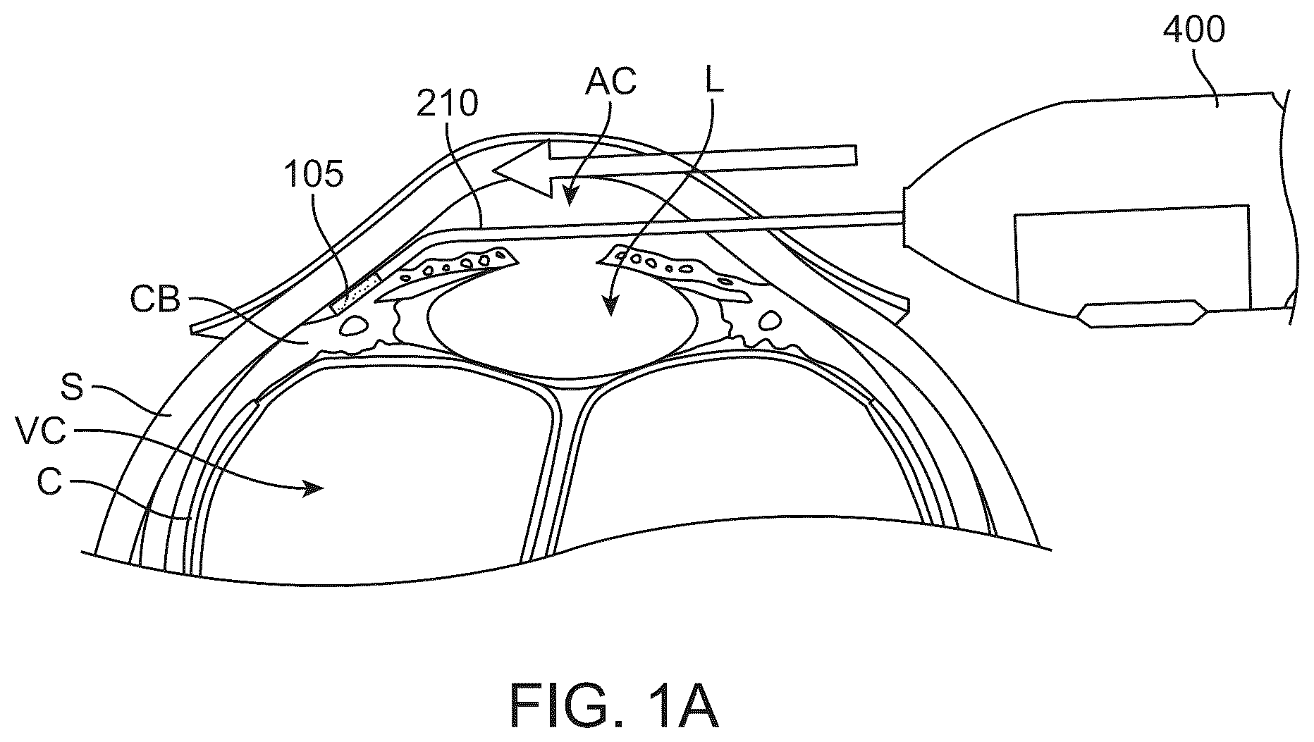 Patent US12318328 Figure 1 – System for shaping and implanting biologic intraocular stent for increased aqueous outflow and lowering of intraocular pressure