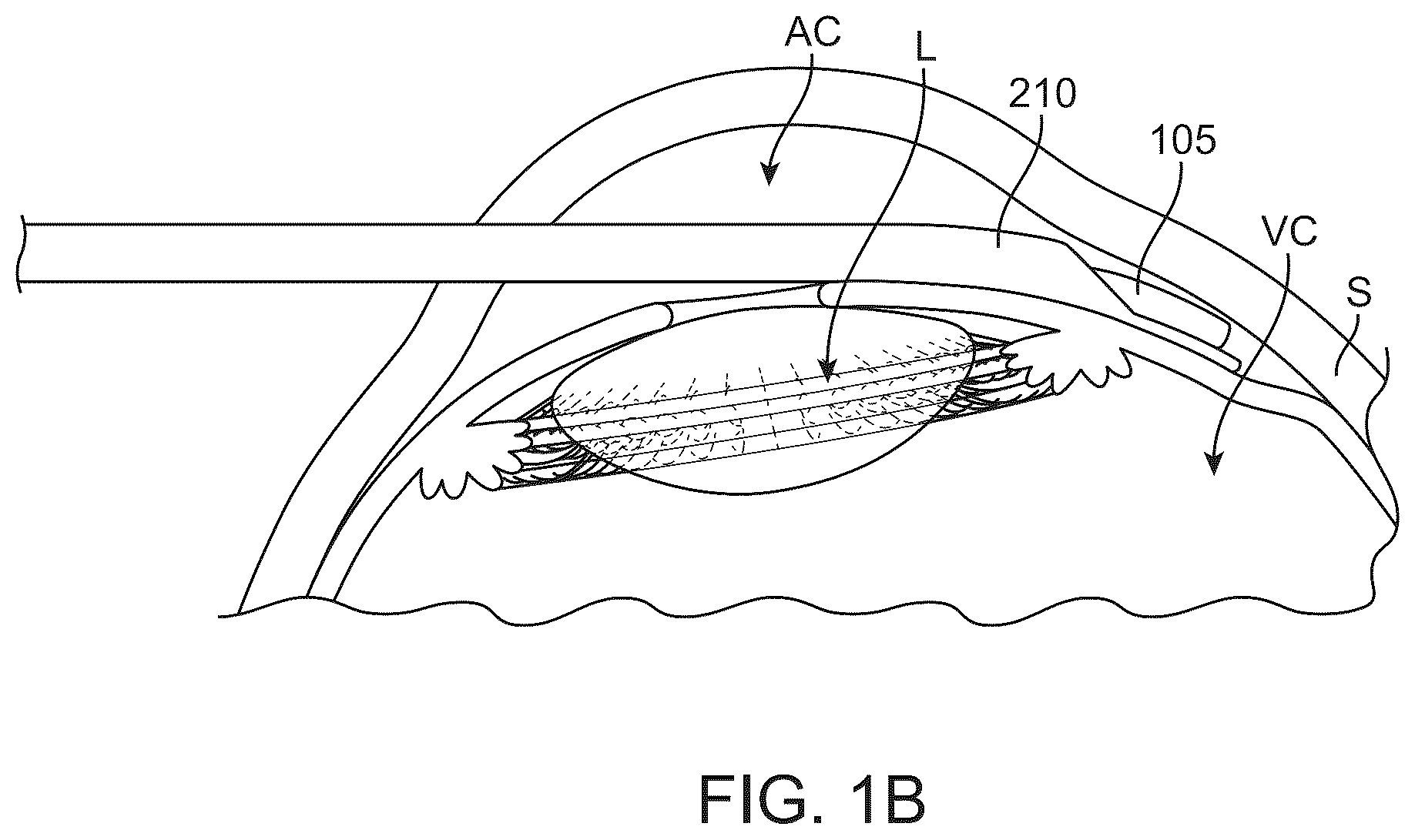 Patent US12318328 Figure 2 – System for shaping and implanting biologic intraocular stent for increased aqueous outflow and lowering of intraocular pressure