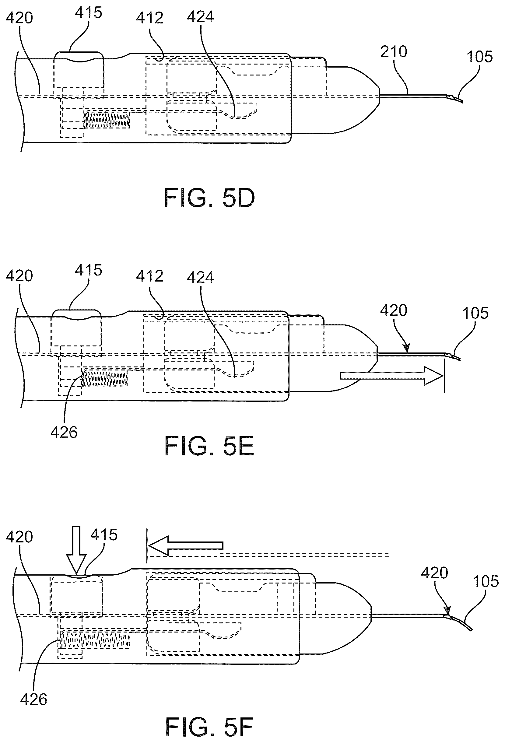 Patent US12318328 Figure 13 – System for shaping and implanting biologic intraocular stent for increased aqueous outflow and lowering of intraocular pressure